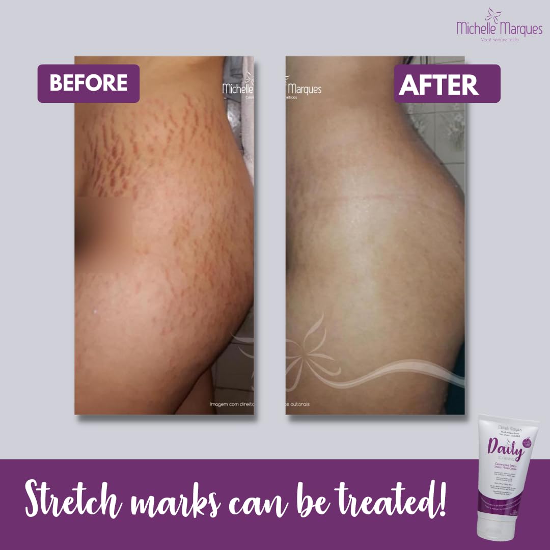 Michelle Marques Stretch Mark Cream, Soften and Reduce the Appearance, Provides Hydration, and Improves Skin Elasticity and Texture, 5.29oz