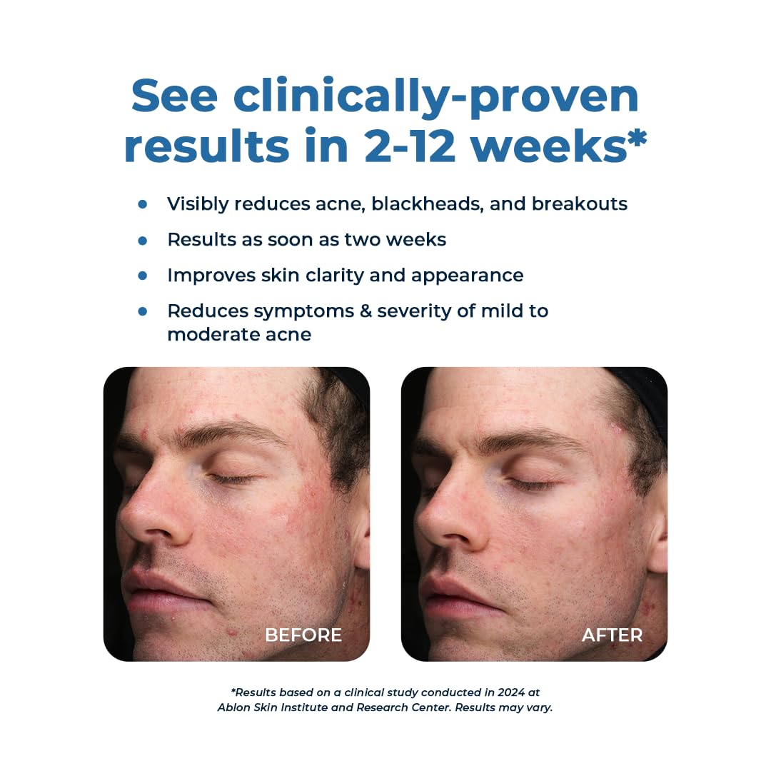 VitaMedica Clear Skin Vitamin Formula | Acne Supplement for Skin Clearing | Breakout Treatment for Women and Men | Vitamins A, C, E, Selenium, Chromium, and Zinc for Acne and Skin Health | 60 Count