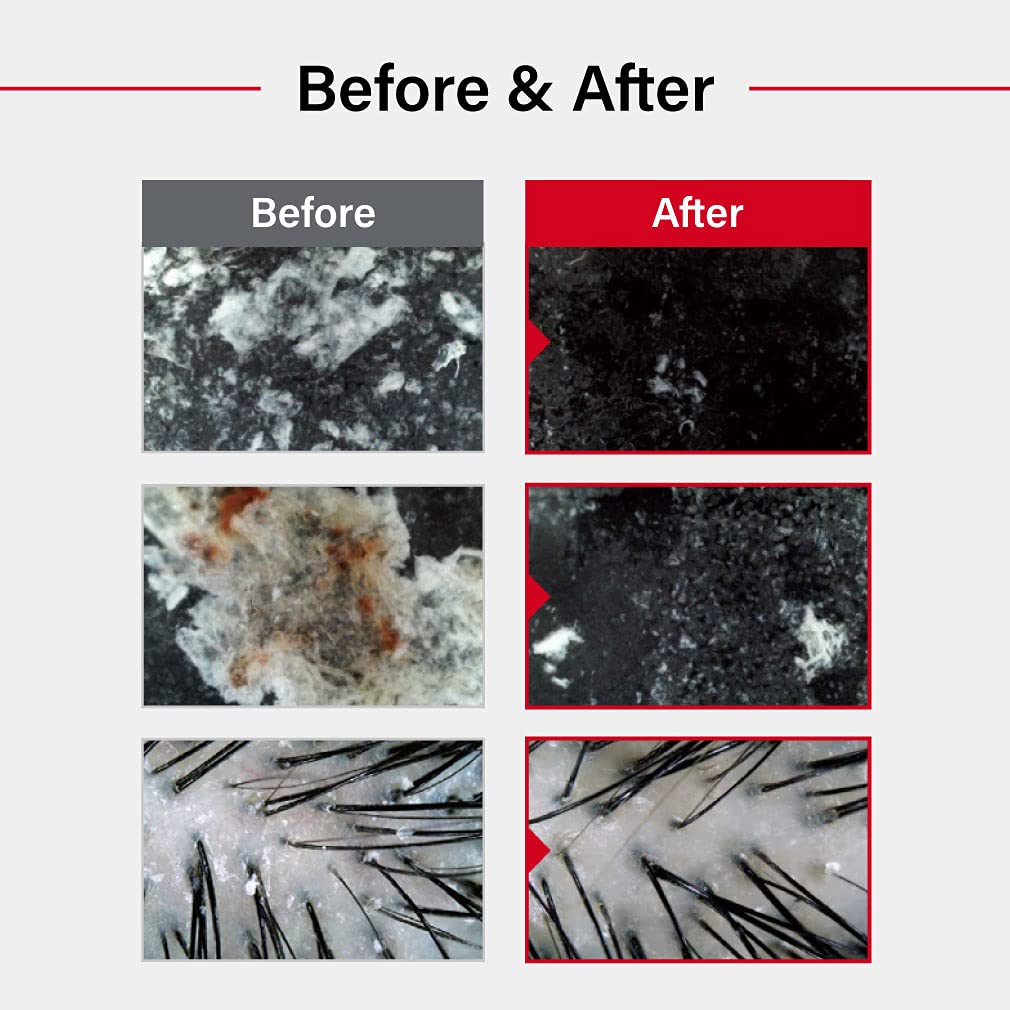 Dr.FORHAIR Folligen Sea Salt Scaler Scalp Scrub (10.5oz) | 45% Sea Salt | Exfoliate Hair Deep Cleansing Excess Sebum Oily Greasy Hair | Dry Flaky Itchy Treatment (No Parabens, Silicone, Sulfates)