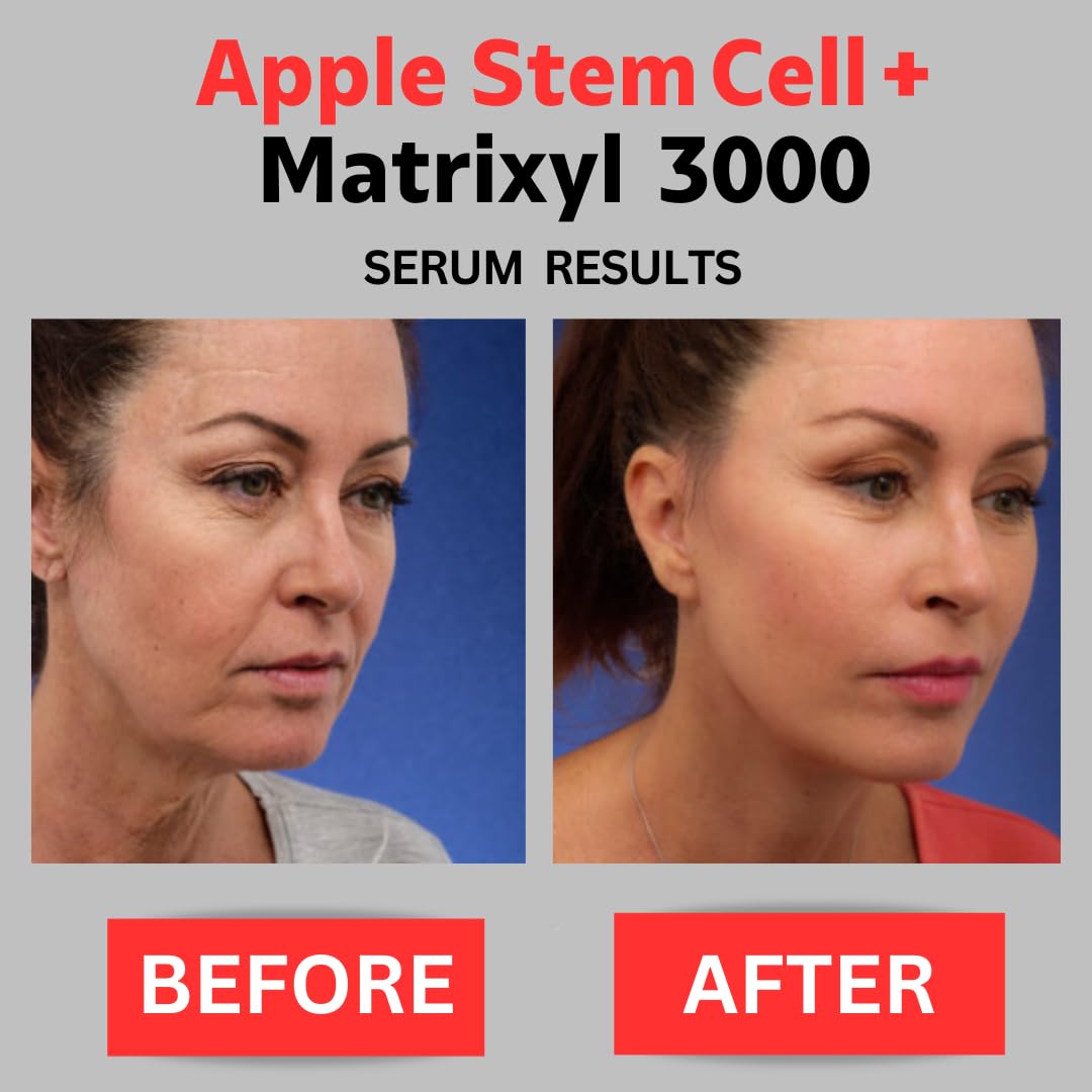 Apple Stem Cell + Matrixyl 3000 Serum With Hyaluronic Acid, Peptide Serum, Anti-Aging Serum for face, Anti-Wrinkle Serum, Skin Care Product - 4 oz