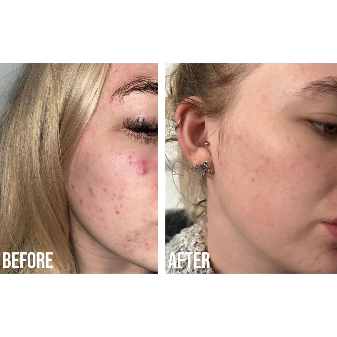 Nip+Fab Retinol Fix Blemish Gel Treatment 10% Complex, 0.5 fl. oz., 0.1% Ensapsulated Pure Retinol, 2% Niacinamide, 2% Trivalin, 0.5% Salicylic Acid to Target Blemishes, Dark Spots and Pore Size