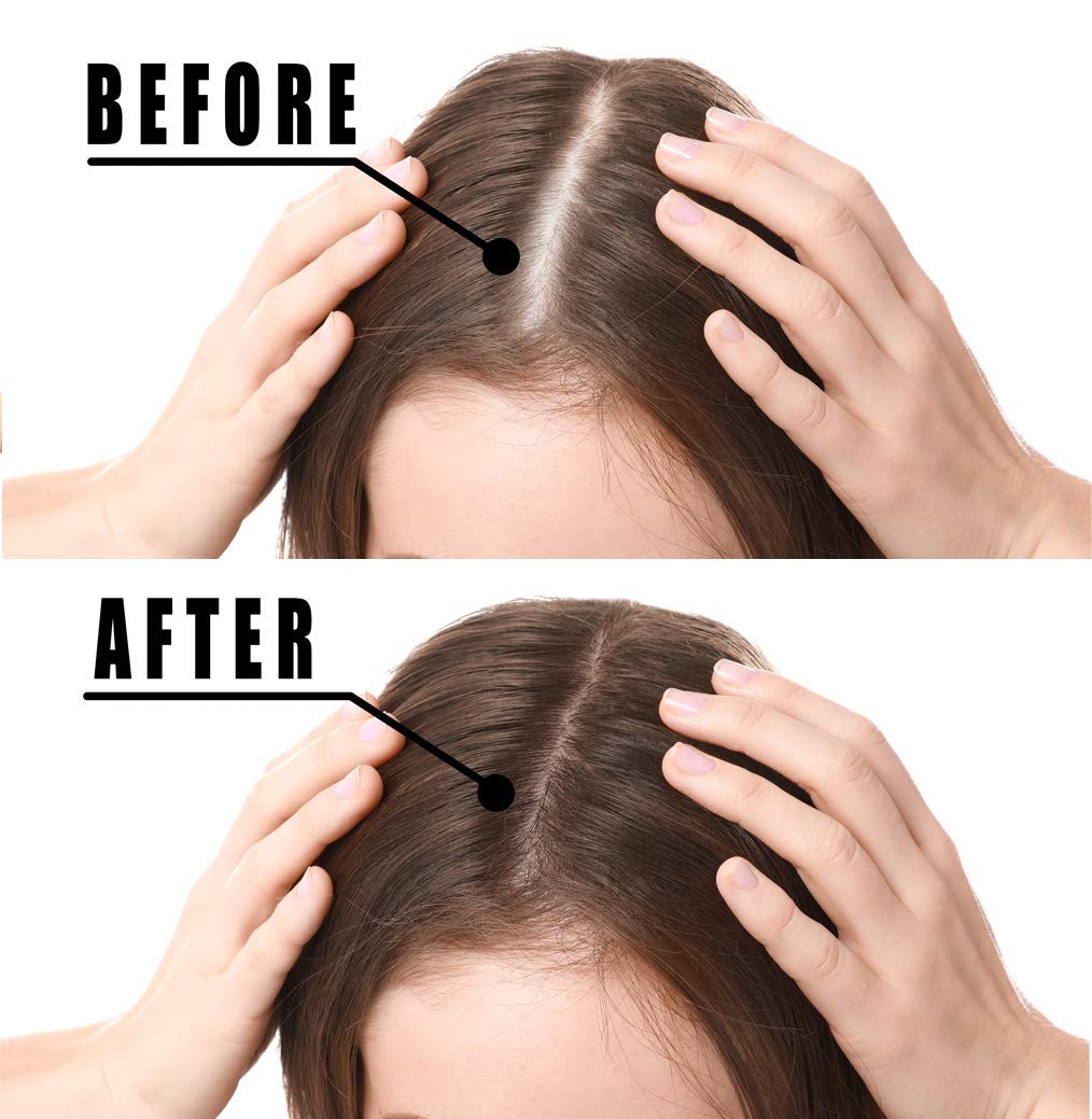 Hair Growth Serum, Votala Hair Growth Treatment, Hair Serum, Anti Hair Loss, Thinning, Balding, Repairs Hair Follicles, Promotes Thicker, Stronger Hair, And Promotes Hair Regrowth