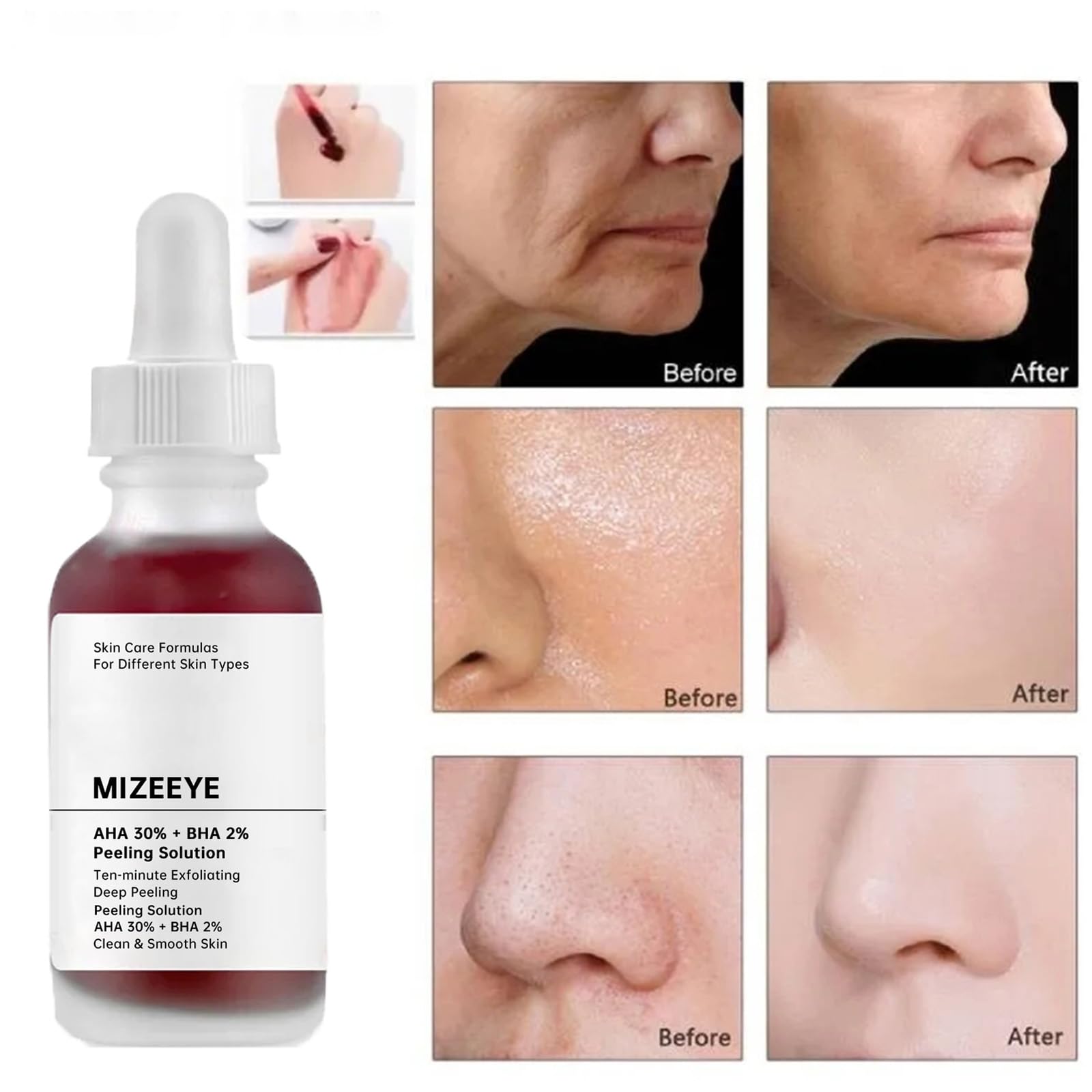 Peeling Solution 30ML, AHA 30% + BHA 2% Anti Acne Serum For Face, 2 PCS Exfoliating Facial Serum, Reduces Pore Congestion & Fine Line.