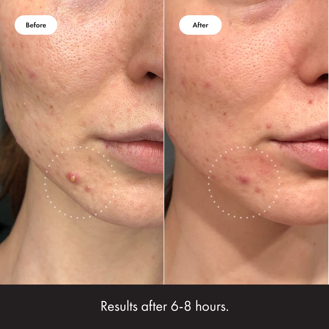 Mighty Patch™ Invisible+ Patch - Daytime Hydrocolloid Acne Pimple Patches for Covering Zits and Blemishes, Ultra Thin Spot Stickers for Face and Skin (24 Medium and 15 Small Patches)