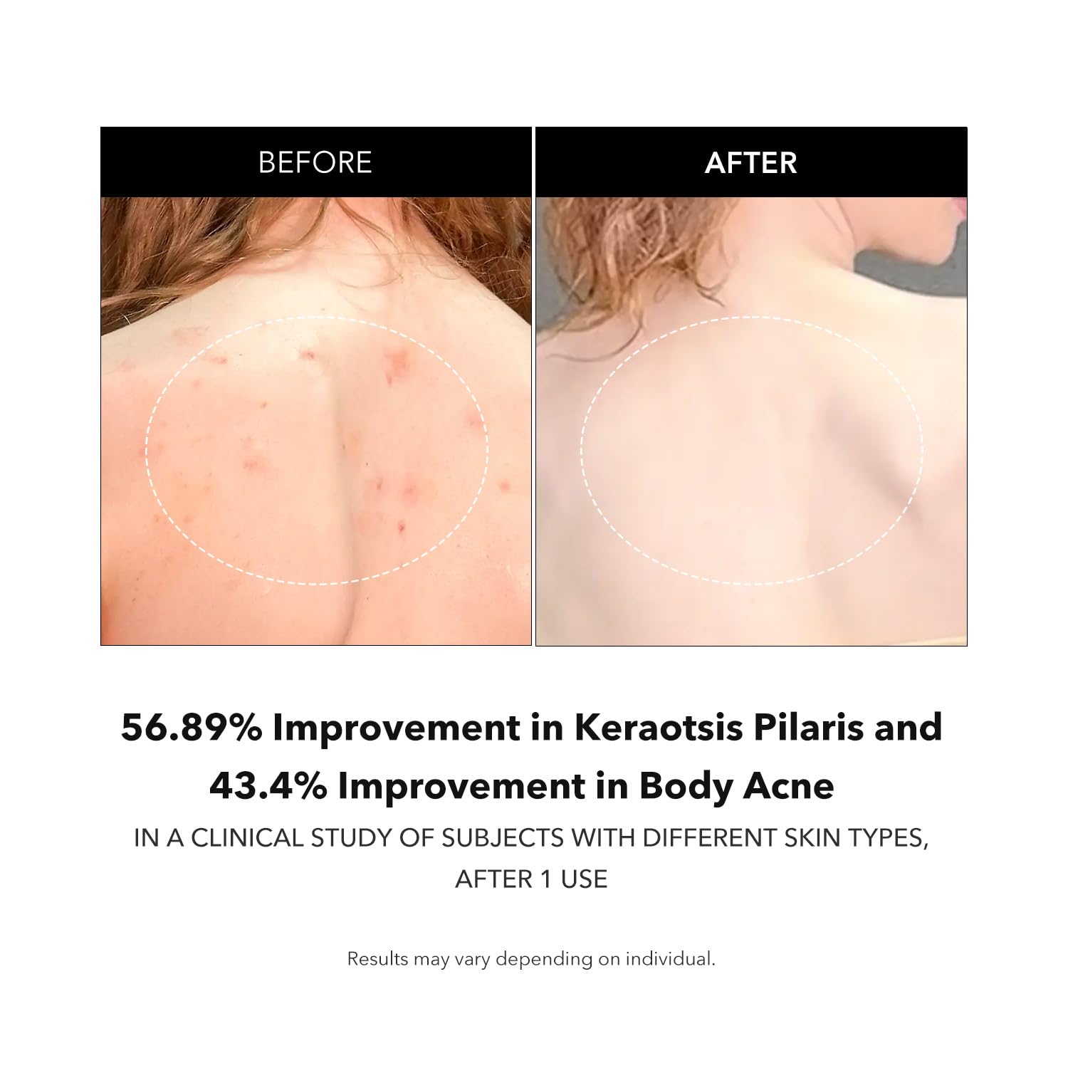 APRILSKIN Carrotene IPMP™ Exfoliating Body Wash | Salicylic Acid Body Wash Improve Rough & Bumpy Skin, Body Acne, Keratosis Pilaris with Niacinamide & Ceramides | Vegan & Cruelty-free | 10.14 fl.oz