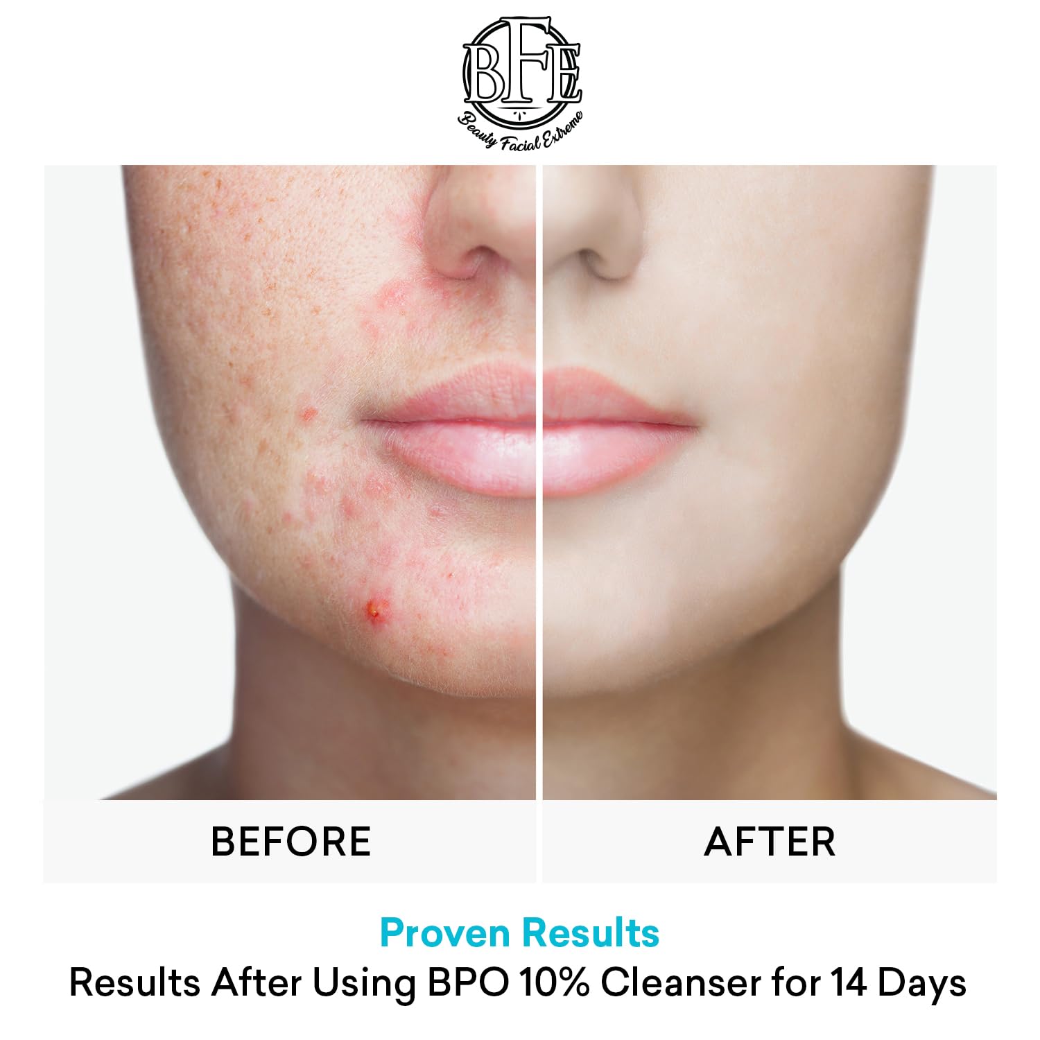 Acne Face wash Treatment with Benzoyl Peroxide 10% - Fight Acne Blemishes on Contact for Cystic Breakouts, Oily Skin, Clogged Pores, Blackhead, Whitehead & Pimples. Achieve Clear Skin.