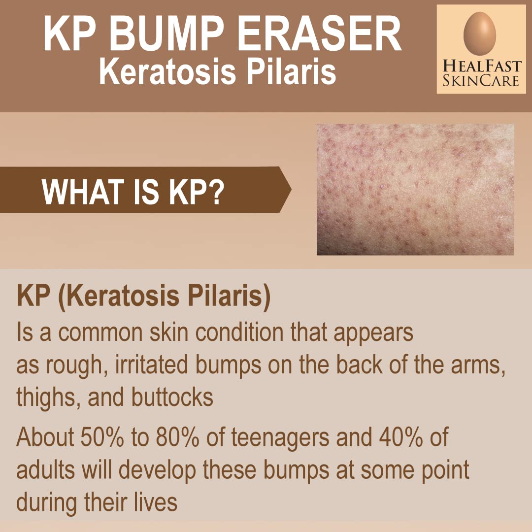 HealFast KP Bump Eraser Cream 4 Oz – Soften, Nourish Rough and Bumpy Skin with 2% BHA – Keratosis Pilaris - For All Types – No Scrubbing Required – Fragrance and Paraben Free