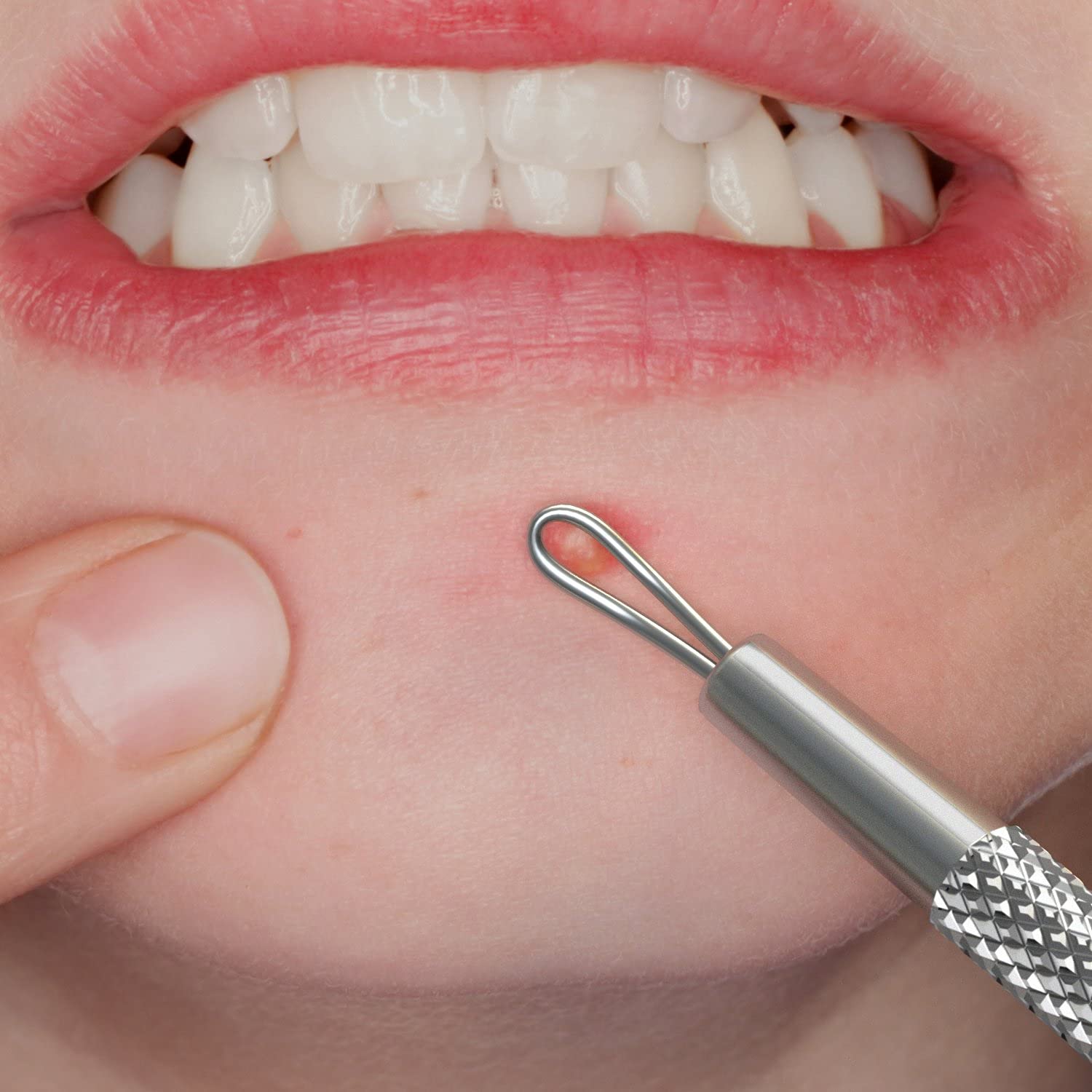 SC-1103-SSP Suvorna Whitehead / Acne Remover & Comedone Extractor