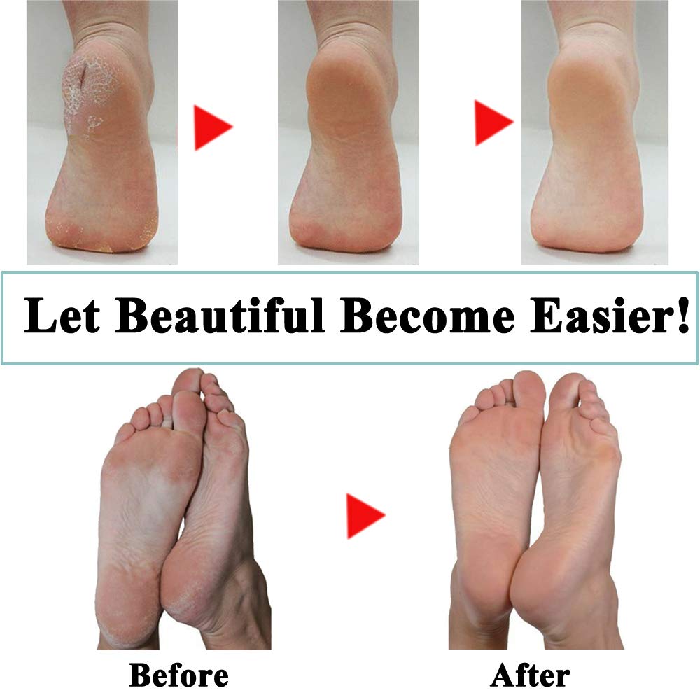 7 Extra Coarse & 7 Regular Coarse Replacement Roller Refill Heads Compatible With Pedi Pefect Electronic Foot File