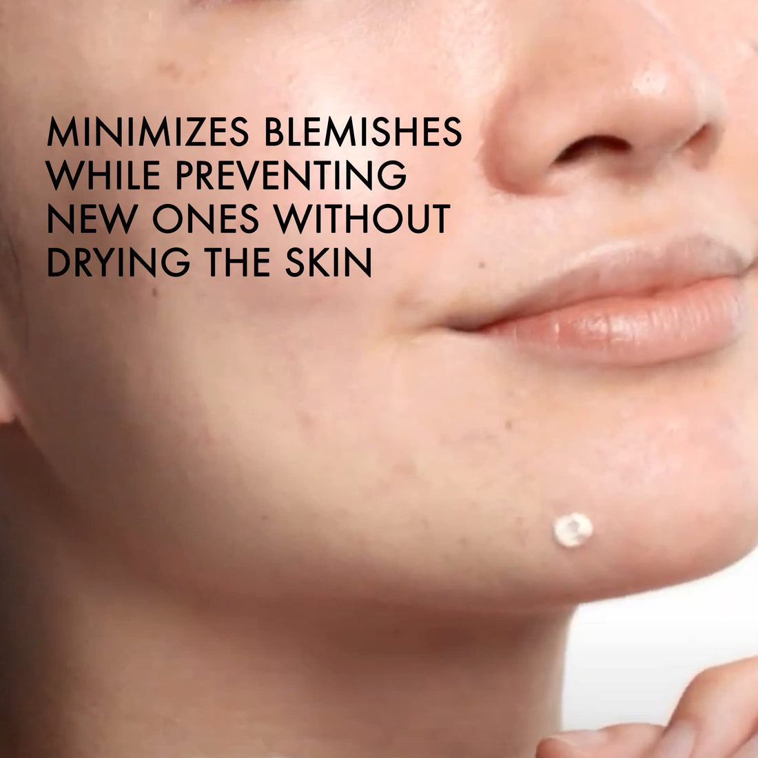 Vichy Normaderm S.O.S Acne Rescue Spot Corrector, Acne Spot Treatment for Face with 10% Sulfur, Niacinamide & Glycolic Acid, Suitable for Sensitive Skin