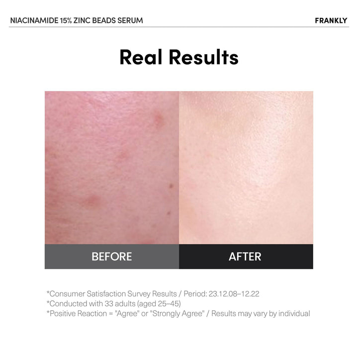 FRANKLY Niacinamide 15% & Zinc Beads Serum: Acne & Dark Spots Care, Oil Control, Even Skin Texture & Glow | Vegan & Cruelty-Free | Non-Comedogenic All skin types Korean Skincare | 1.01 fl.oz