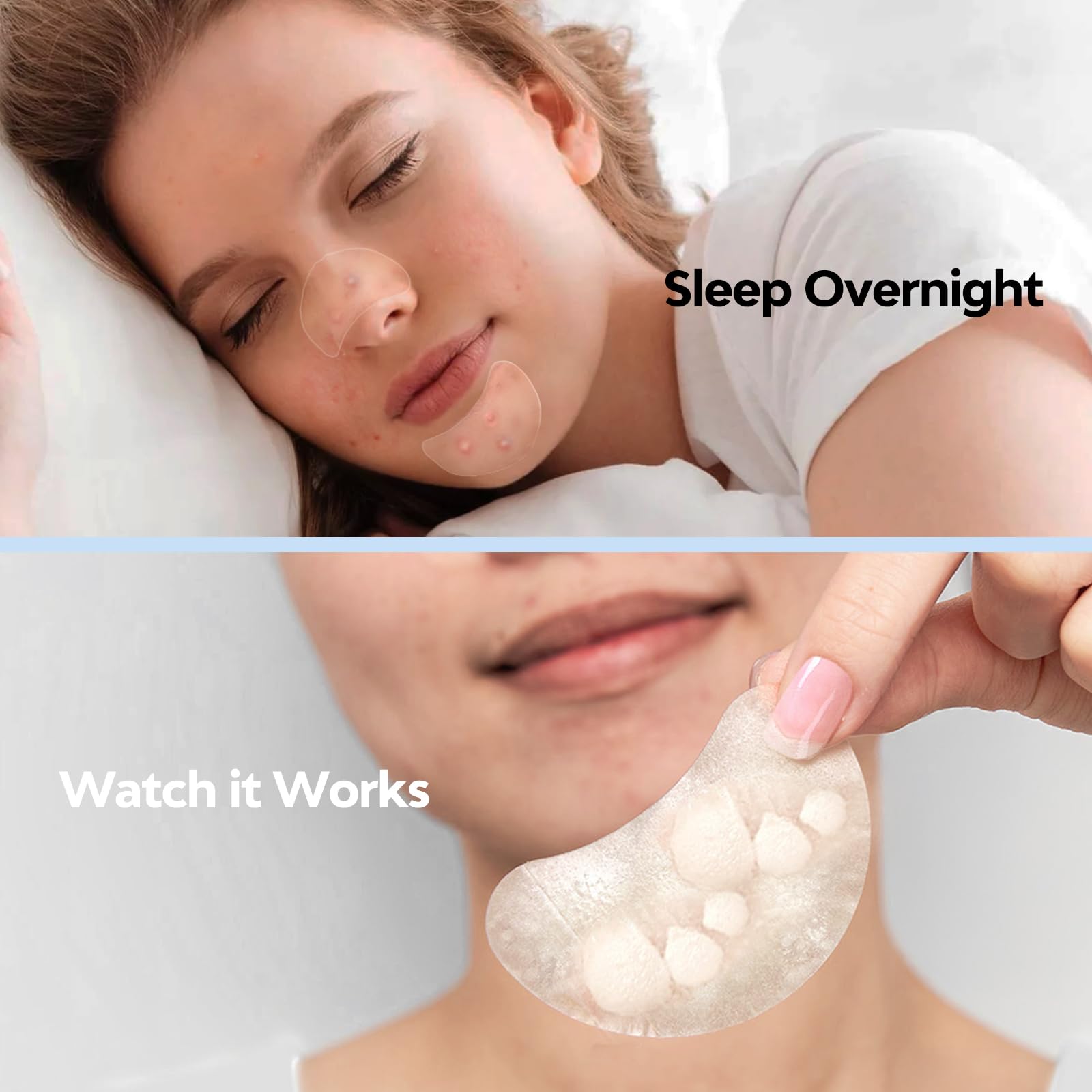 Large Pimple Patches for Face 331 Patches-7 Size,306 Round & 25 XL Acne Patches,Zit Patches Skincare Hydrocolloid Bandages Big Spot Covers with Tea Tree, Salicylic Acid & Cica Oil|Bigpack, Larger Size