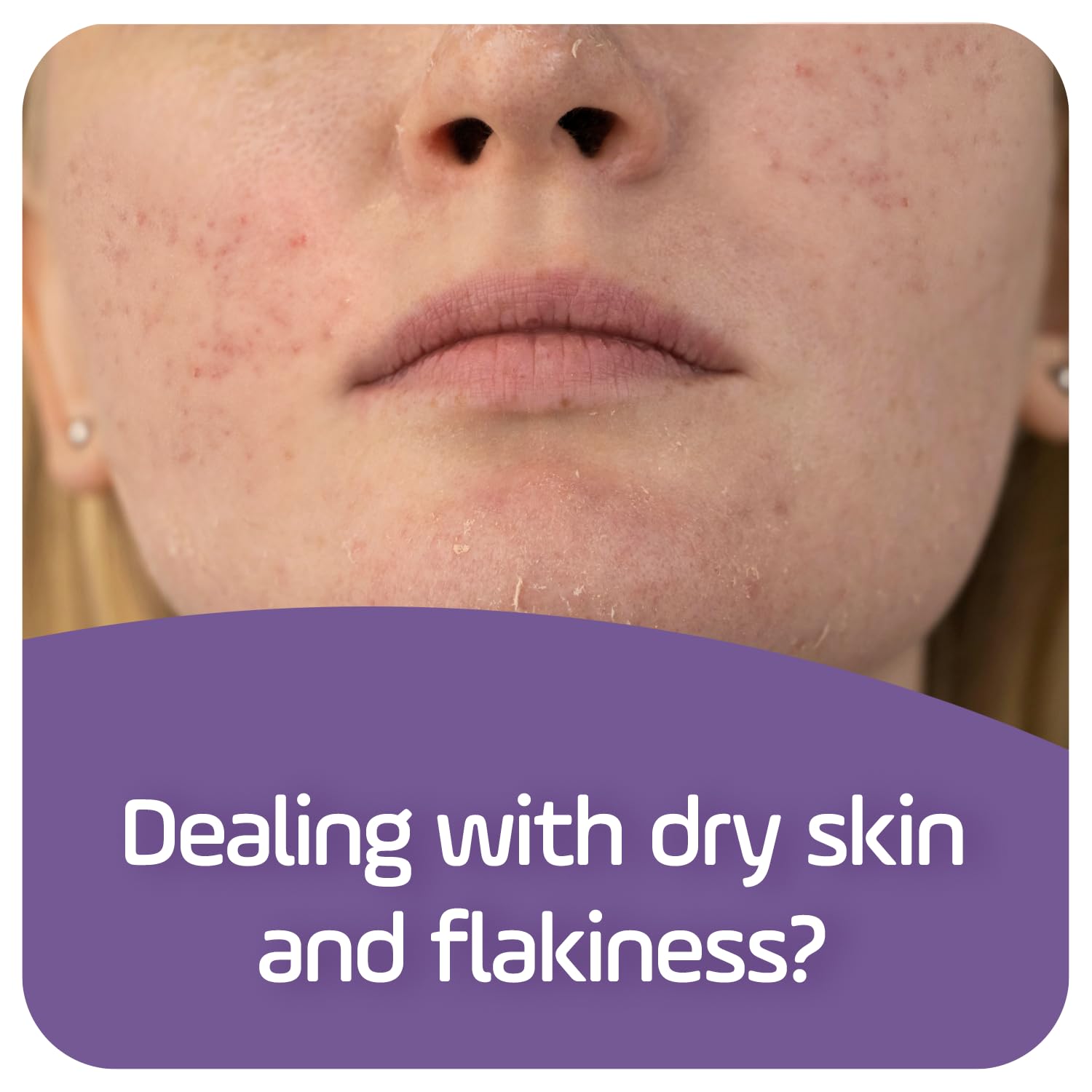 ASEPXIA Cleansing Bar Softening, 4 Ounce Multipack (Pack of 5)