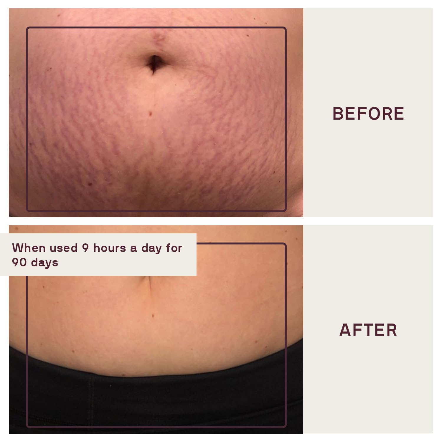 Dermaclara Large Body Patch - Pregnancy Stretch Mark Prevention & Removal, C Section Cover Up Belly Scar, Maternity Skincare, Silicone Gel Sheet, Reusable up to 30 Times - 2 Patches & Patch Cleanser