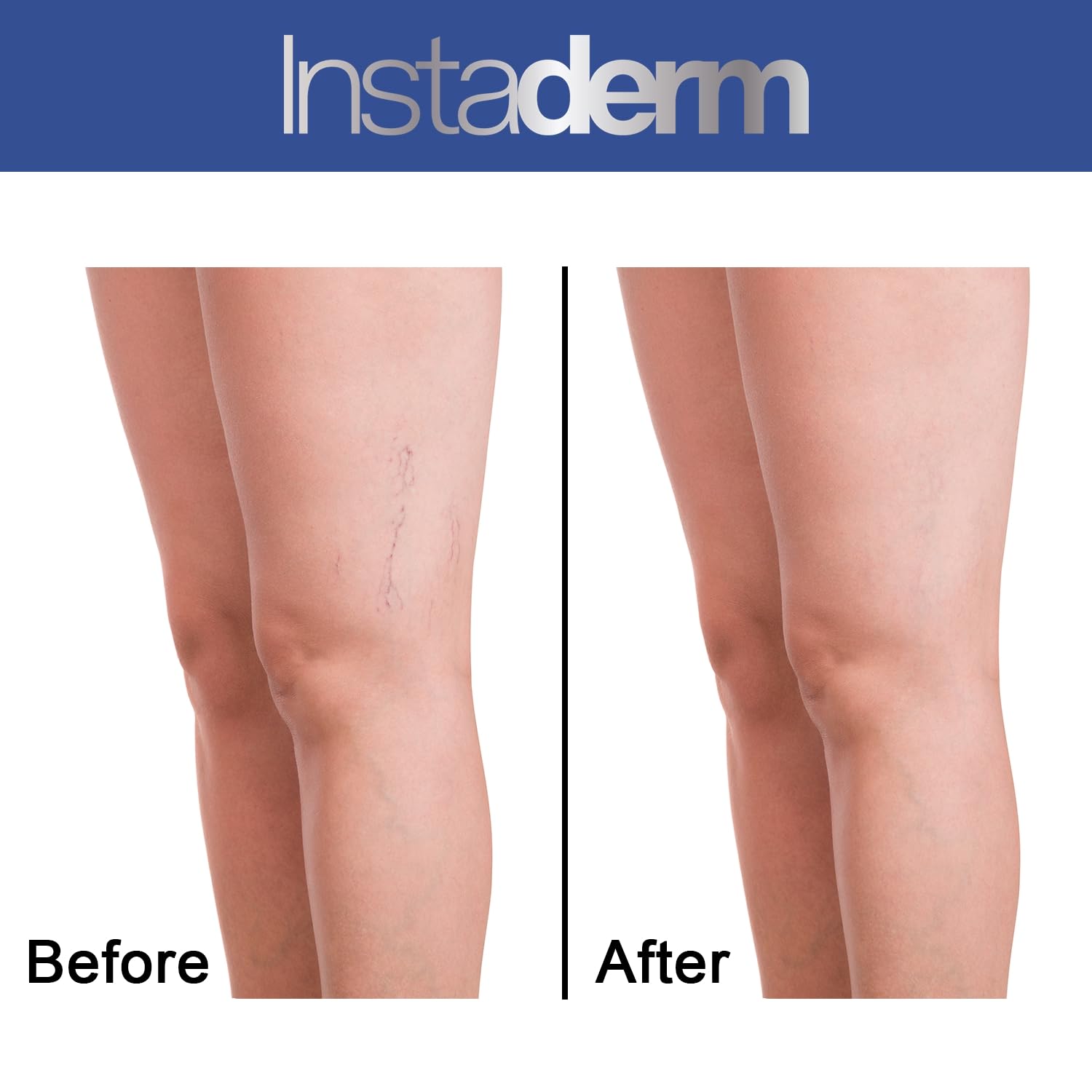 Vitamin K Cream- Bruise Healing Formula with Arnica. Dark Spot Moisturizer for Bruising, Spider Veins & Broken Capillaries. Repair Under Eye Dark Circles, Fine Lines, Puffiness, Wrinkles.