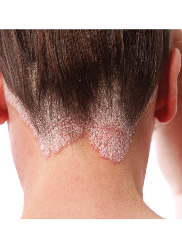 TriDerma Psoriasis Control Scalp Exfoliator Shampoo, 3% Salicylic Acid for Psoriasis, Seborrheic Dermatitis with AP4 Aloe Vera Gel, No Coal Tar, Fresh Scent Rosemary Shampoo - 8.3oz