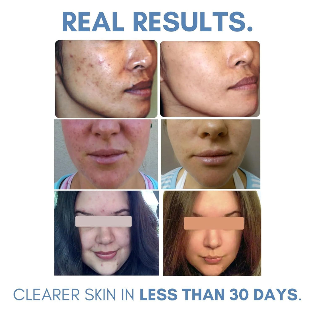 Clearogen Sulfur Acne Lotion Sensitive Skin, Fresh Botanical, 1.8 fl.oz.