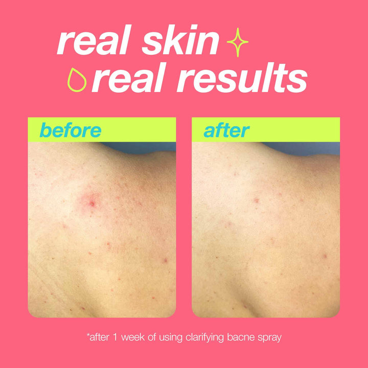 Dermalogica Clear Start Clarifying Bacne Spray - Back Acne Treatment Spray for Body Breakout, Pore Clearing, Preventing Pimple with Salicylic Acid, Witch Hazel, Tea Tree Oil, All Skin Type - 6 fl oz