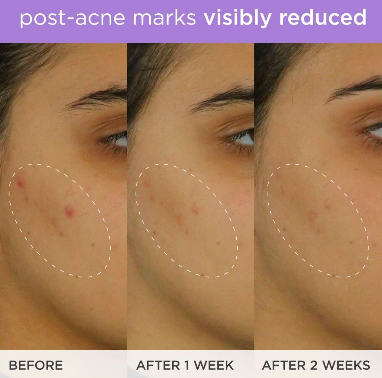 The Brightening Serum | Vitamin C Treatment for Brighter, Firmer Skin – Targets Hyperpigmentation & Fades Post-Acne Marks, 30 ml / 1.0 fl. oz.