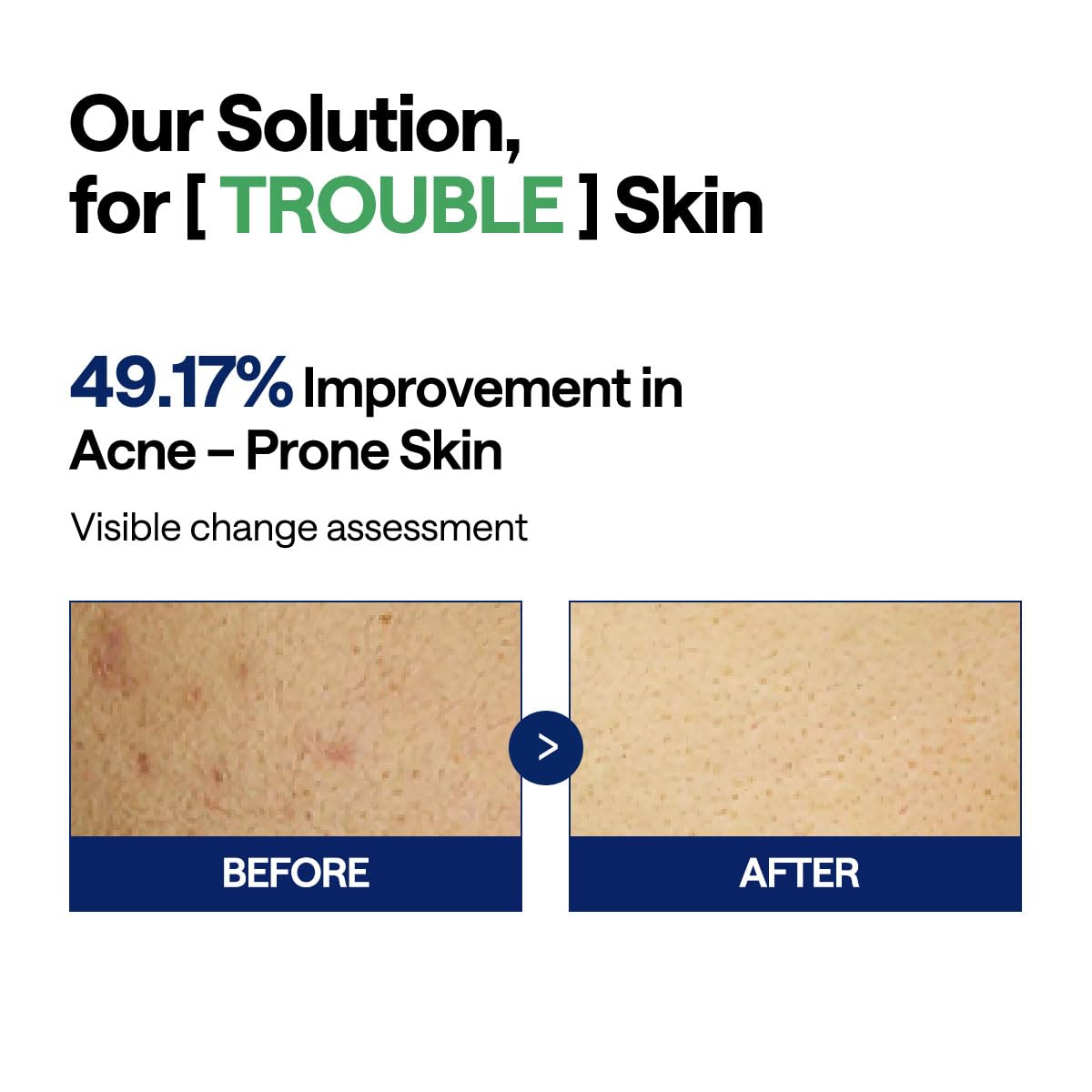 MEDIHEAL Teatree Trouble Facial Toner Pads with Tea Tree & Lactobacillus - Calming & Soothing for Sensitive & Acne Prone Skin - Vegan Face Gauze, 100 Pads