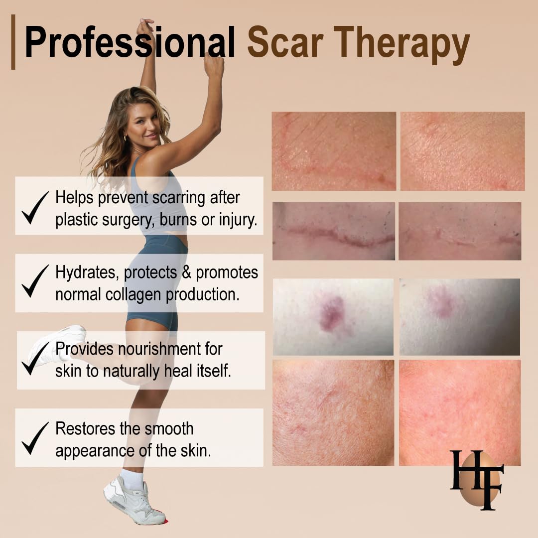 HealFast The Original Scar Cream for Stretch Marks – Soothes, Nourishes and Refreshes Skin – Using Ovasome Technology with Allantoin & Alpha LIpoic Acid – 2 Oz/ 60 ml