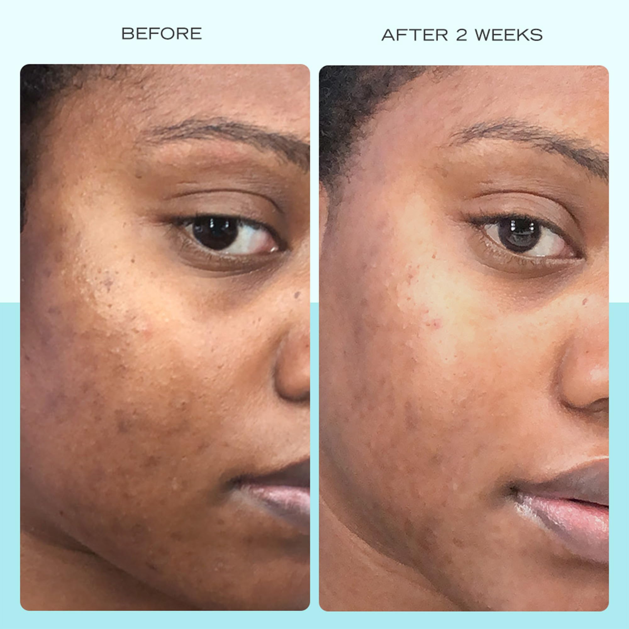 First Aid Beauty - Dark Spot Serum with Niacinamide, Helps Reduce Look of Dark Spots, Sun Spots, Hyperpigmentation, Discoloration & Post-acne marks, Non-Comedogenic, Safe for Sensitive Skin, 1 oz