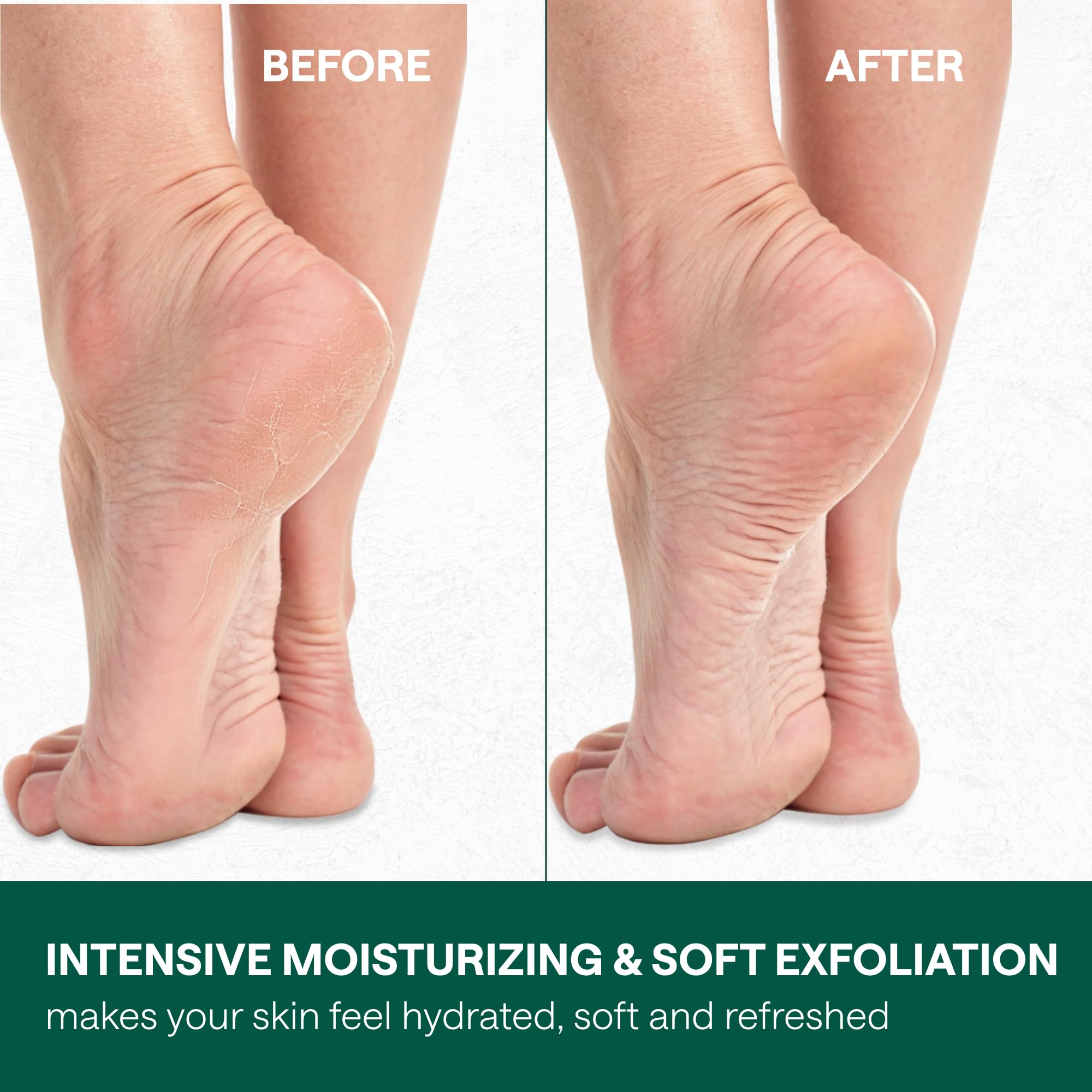 40% Urea Cream for Feet with 2% Salicylic Acid Aloe Tea Tree Oil for Skin - Athletes Foot Cream Extra Strength - Dry Hand Cream for Dry Cracked Hands - Urea Cream 40 Percent for Feet Maximum Strength