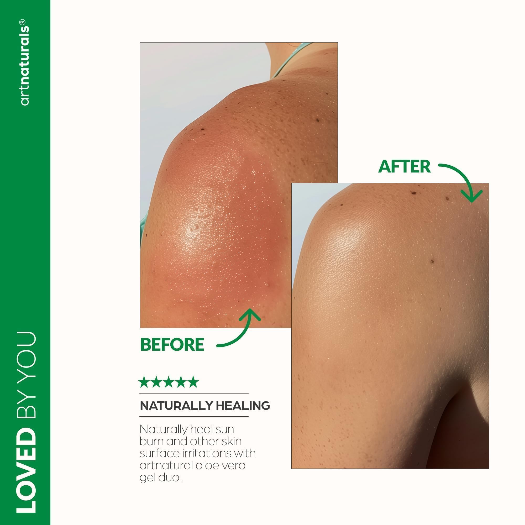 artnaturals Aloe Vera Gel Set - JUMBO 20oz (99% Pure Organic) - Sunburn Relief & Hydration for Face, Body, Scalp & Hair - Calming Moisturizer After Sun Exposure - Freshly Harvested within 12 Hours