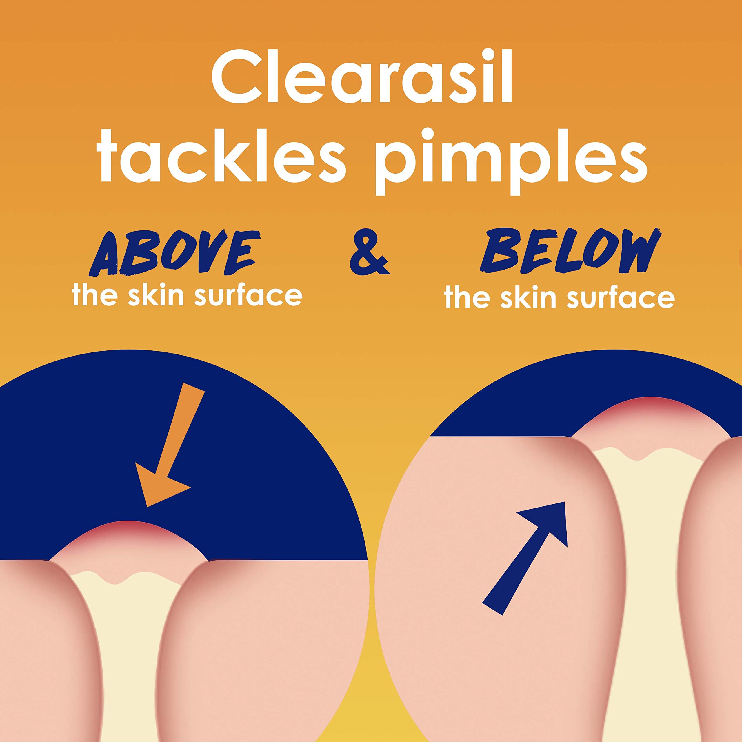 Clearasil Stubborn Acne Control 5in1 Spot Treatment Cream, Maximum Strenght with 10% Benzoyl Peroxide, Acne Medication, 1 oz