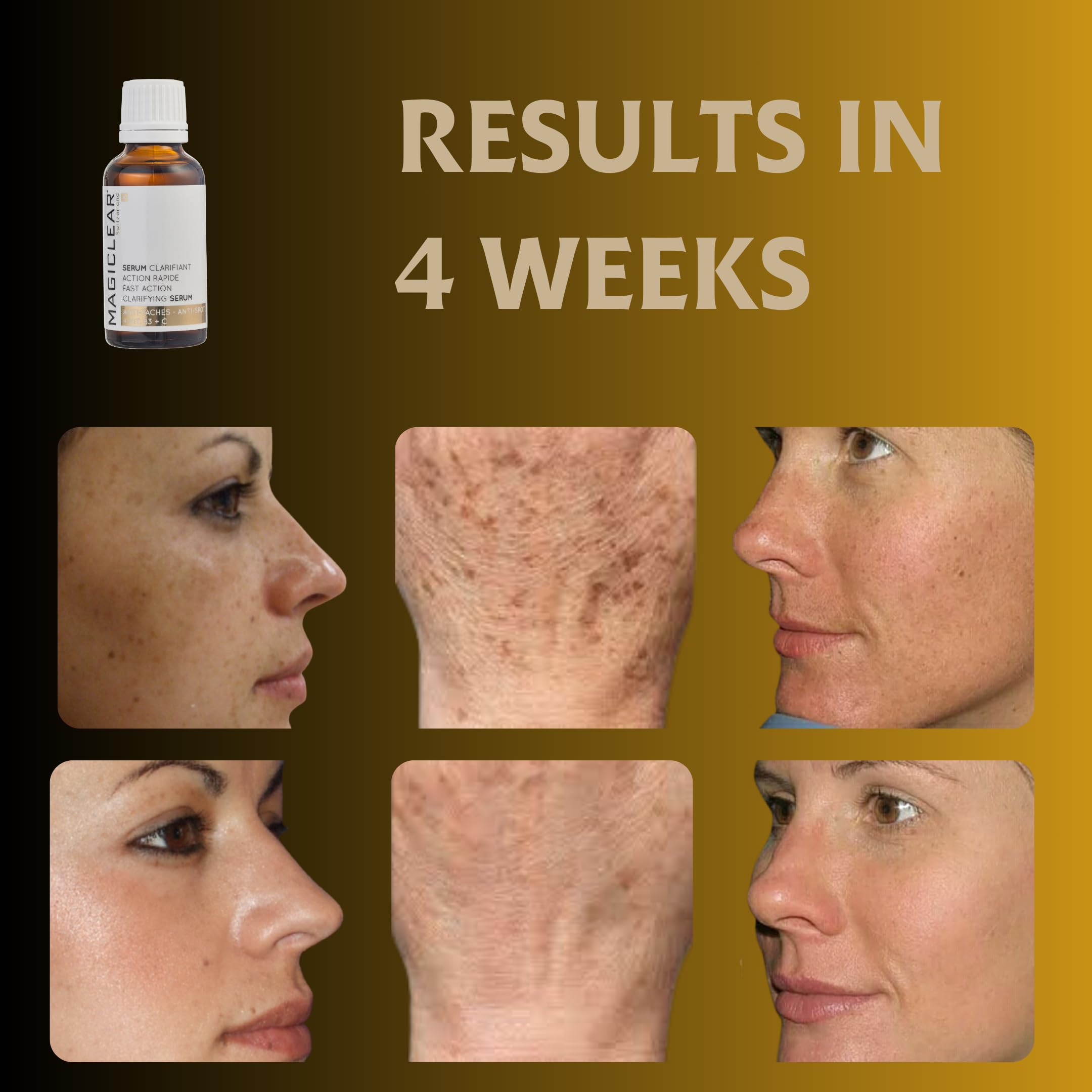 Luxury Swiss Dark Spot Remover for Face Body Serum Age Sun Brown Spot Freckles Corrector Melasma treatment Anti aging Skin Vitamin C + Niacinamide organic Magiclear