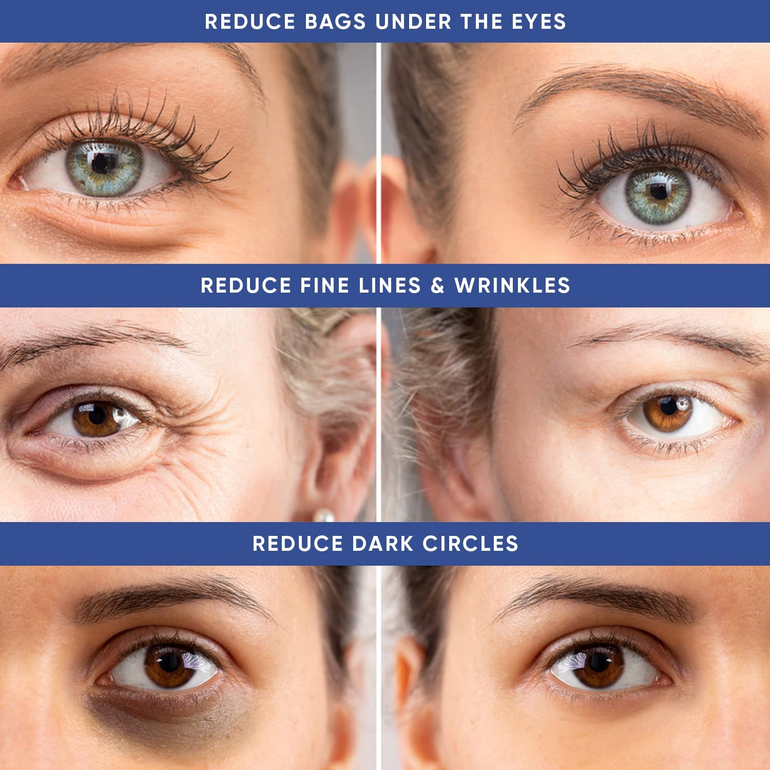 Instant Puffy Eye & Lift Treatment ââ‚¬â€œ Removes Under Eye Bags & Puffiness. Eliminate Dark Circles & Wrinkles. Naturally Ageless Hydrating Cream. Disappears Before Your Eyes Within Minutes.