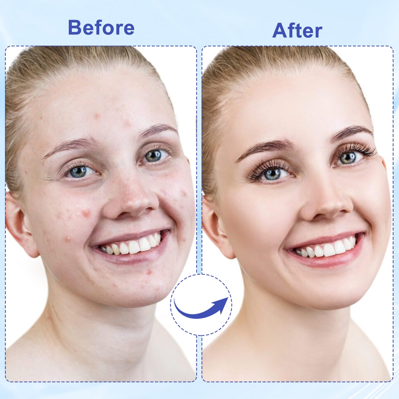 Pimple Patches for Face, 288 Hydrocolloid Acne Patches, Cute Round Shape Zit Covers, Patches for Covering Zits, Colorful Spot Stickers with Tea Tree, Salicylic Acid & Cica Oil