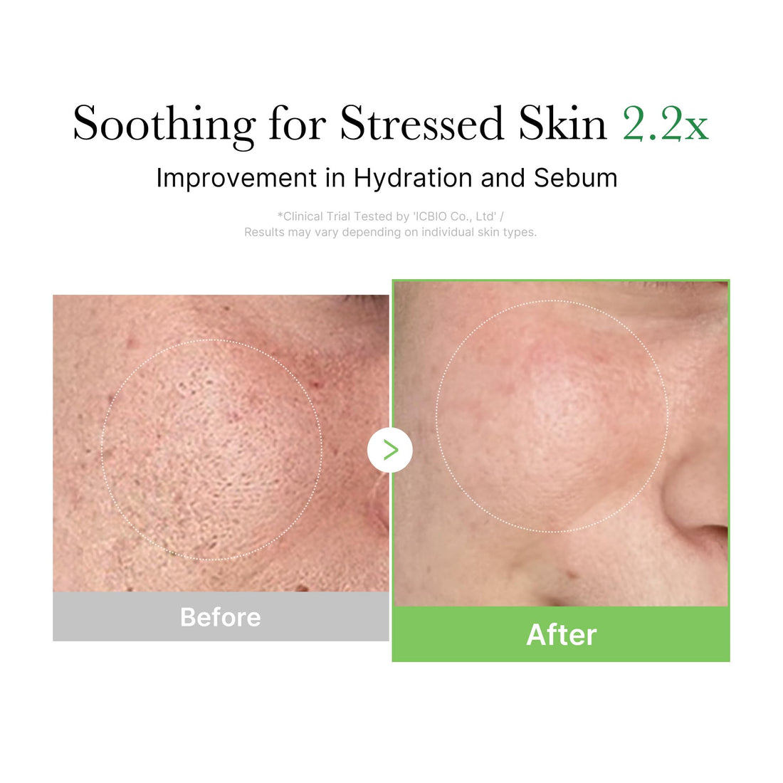 medicube Exosome Cica Tea Tree Cream for Sensitive Skin with Centella Asiatica help reduce redness and breakouts. | Low-irritating, Moisturizing Daily Texture Care | Korean Skincare | 1.7 fl oz