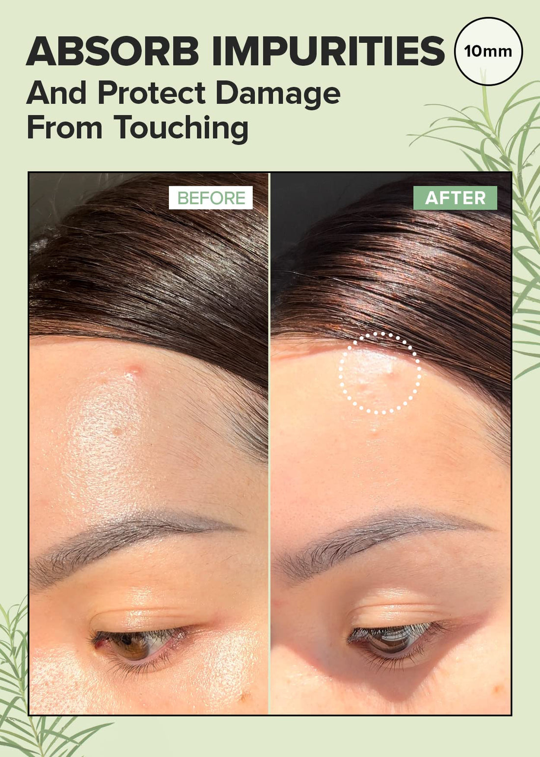 I DEW CARE Hydrocolloid Acne Pimple Patch - Timeout Blemish Original | Korean Zit Dark Spot Patches for Face and Skin, Pus absorbing with Tea Tree Oil, Mother's Day, 36 Count