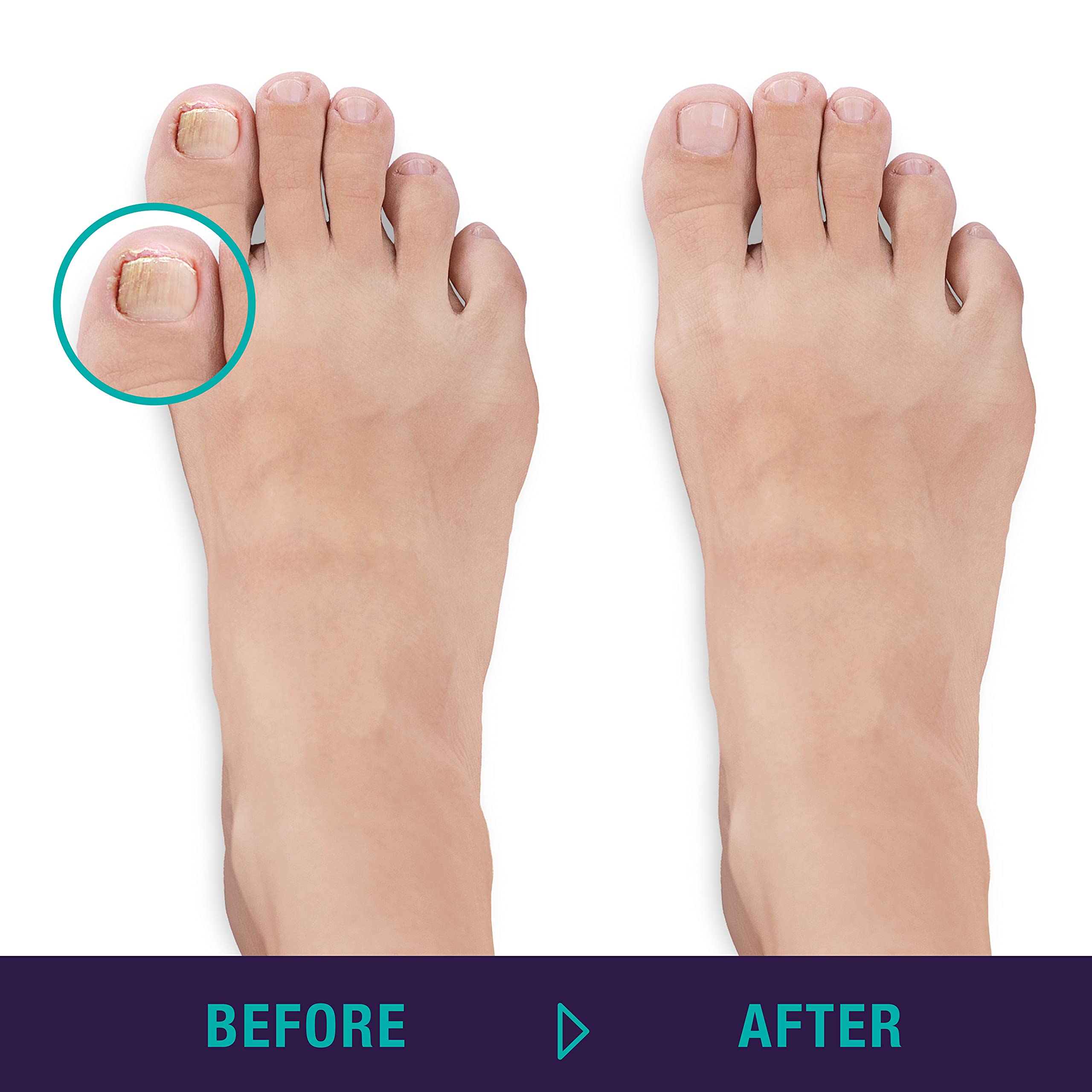 Simply Foot Ingrown Toenail Kit ââ‚¬â€œ Includes a Stainless Steel Toenail Nipper and a Stainless Steel Dual-Ended File ââ‚¬â€œ Easy to Use Foot Care Tools for DIY Pedicures ââ‚¬â€œ Ideal for Men