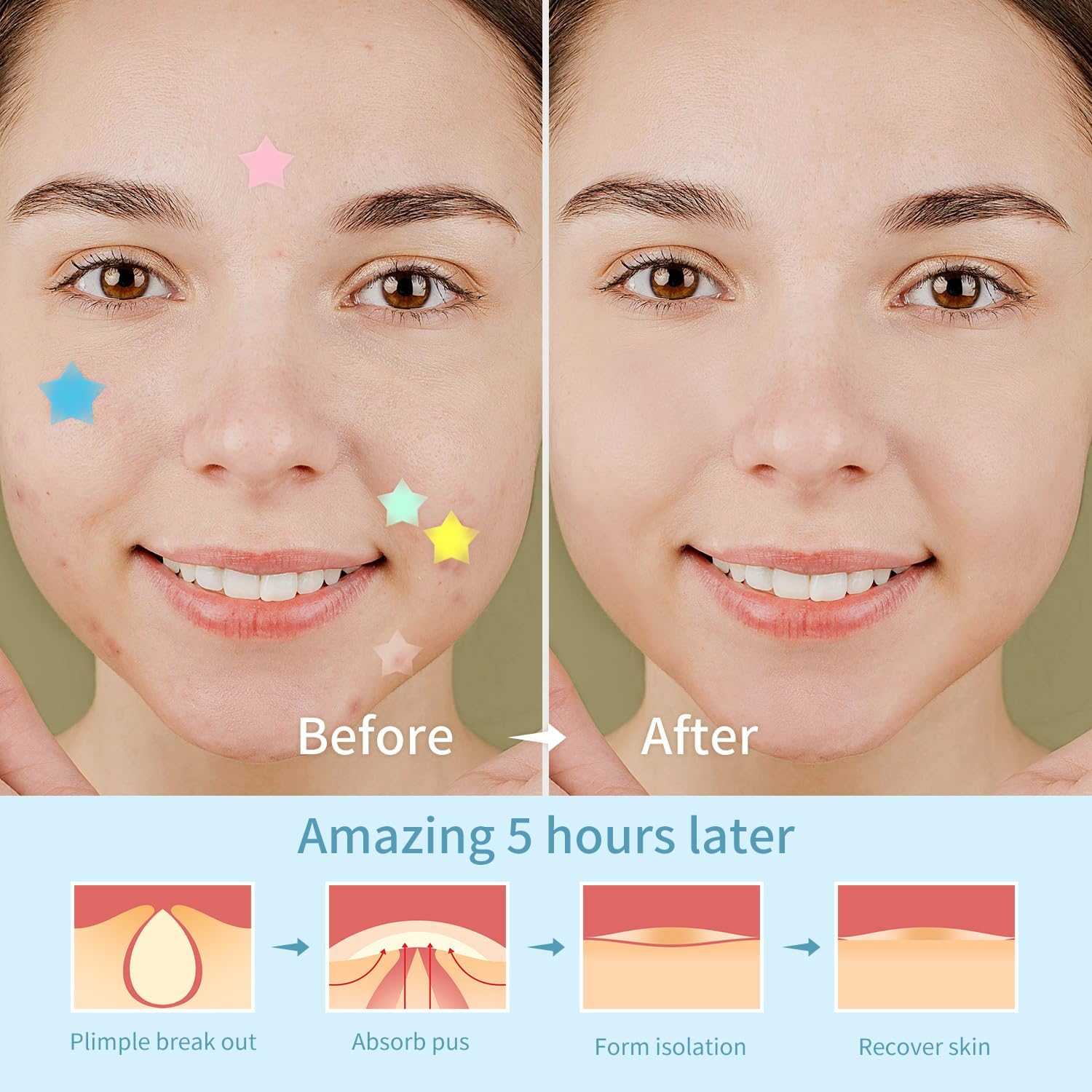 REDANHA 200 Counts Star Patch for Face, Hydrocolloid Acne Pimple Patch with Tea Tree Oil for Party Gift Covering Zits Blemishes