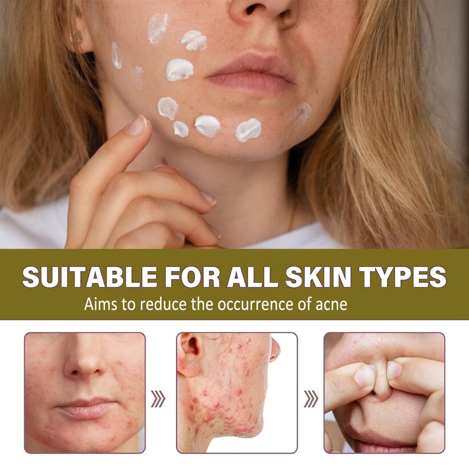 14% Azelaic Acid Skin Perfecting Cream, Reduces Redness, Fades Dark Spots, Evens Texture - Tried and True