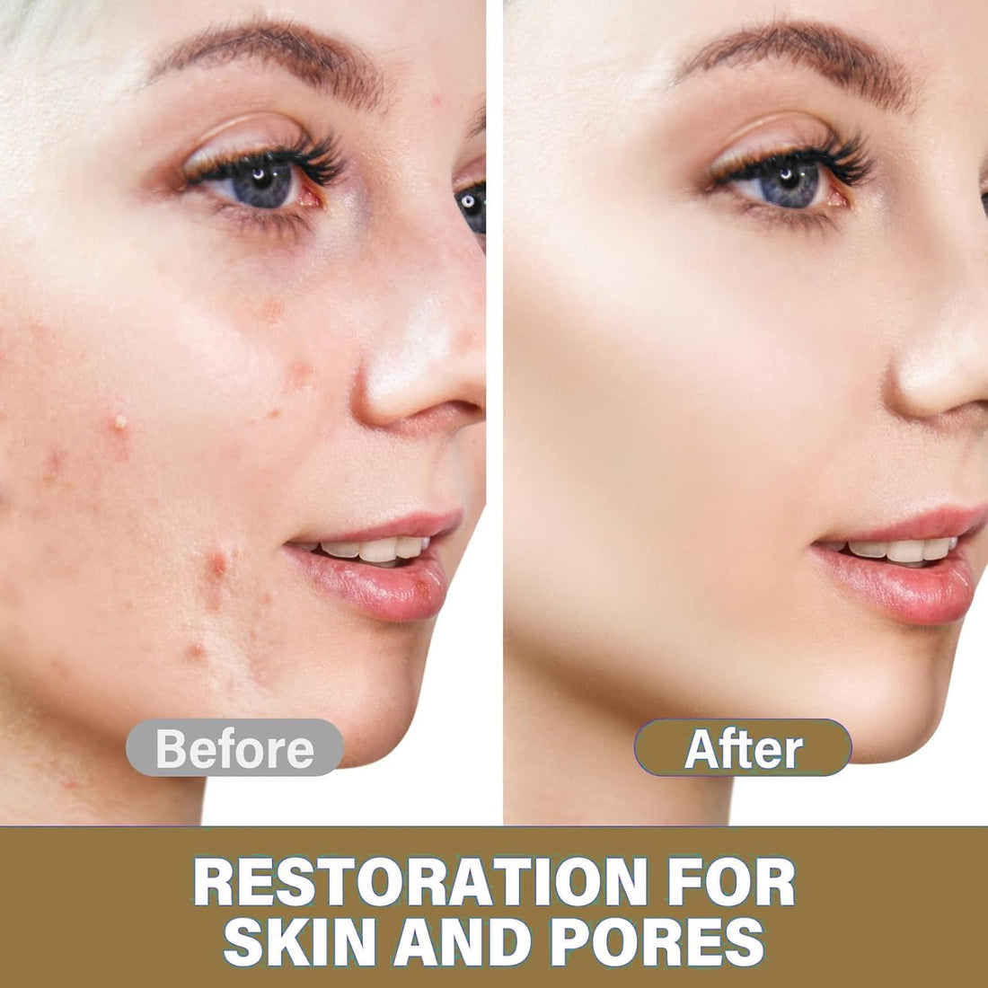 14% Azelaic Acid Skin Perfecting Cream, Reduces Redness, Fades Dark Spots, Evens Texture - Tried and True