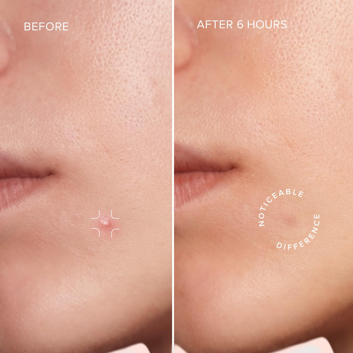 MAREE Star Pimple Patches for Face 2 PACK - Acne Patches - Natural Green Algae Extract & Tea Tree Oil - Hydrocolloid Stars Cute Zit Stickers, Parches Para Acne - Marine Collagen Blemish Pimple