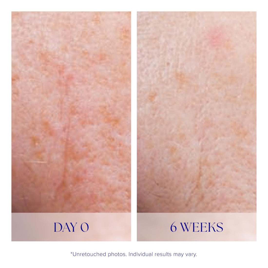 iS CLINICAL Active Serum - 1 Fl Oz | Face Serum for Even Skin Tone, Blemish-Prone, and Anti-Aging | Anti-Blemish Treatment & Hyperpigmentation Serum