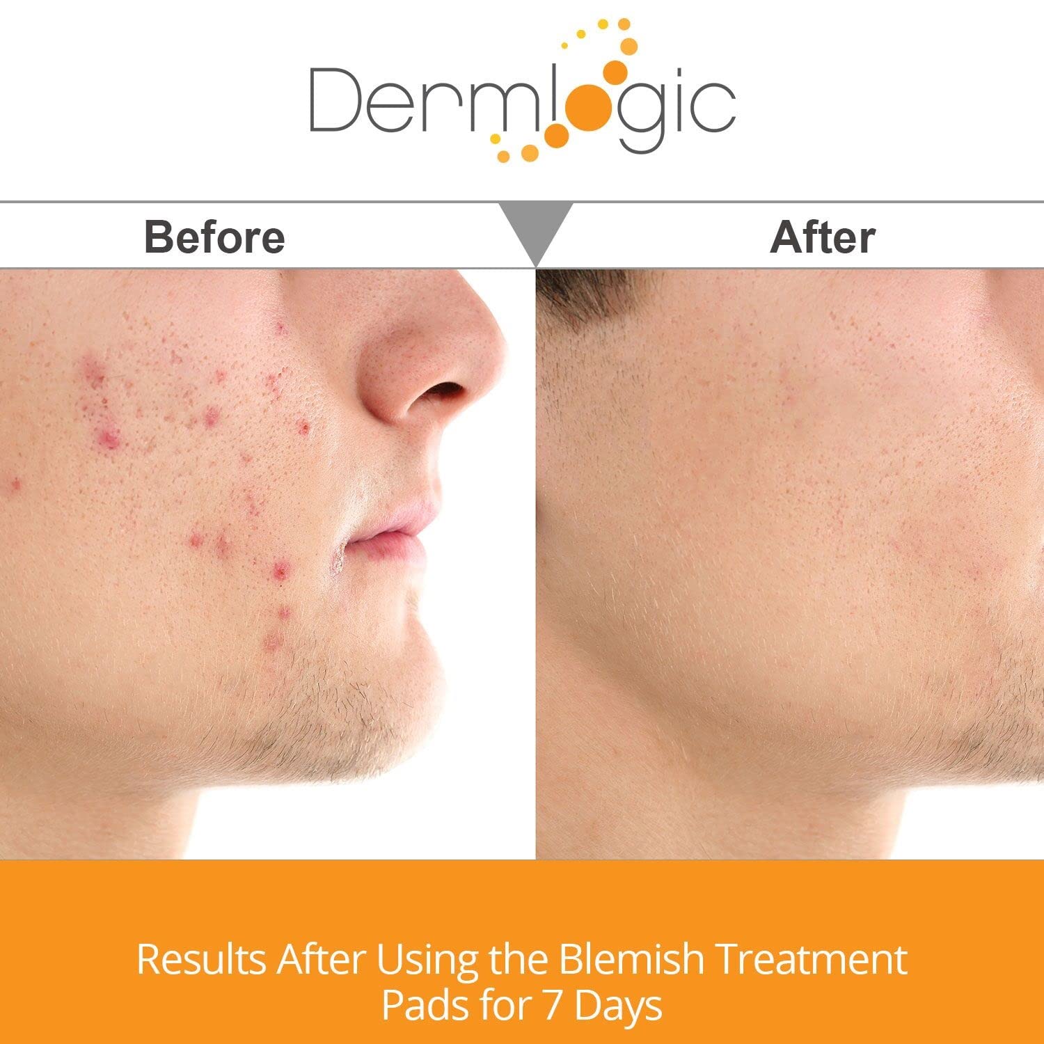 Dermlogic Anti-Blemish Control Pads- Contains Salicylic, Glycolic, Lactic Acid For Face & Body. Clears Away Clogged Pores, Oily Skin & Cystic Breakouts. Removes Dark Spots, Blackhead & White