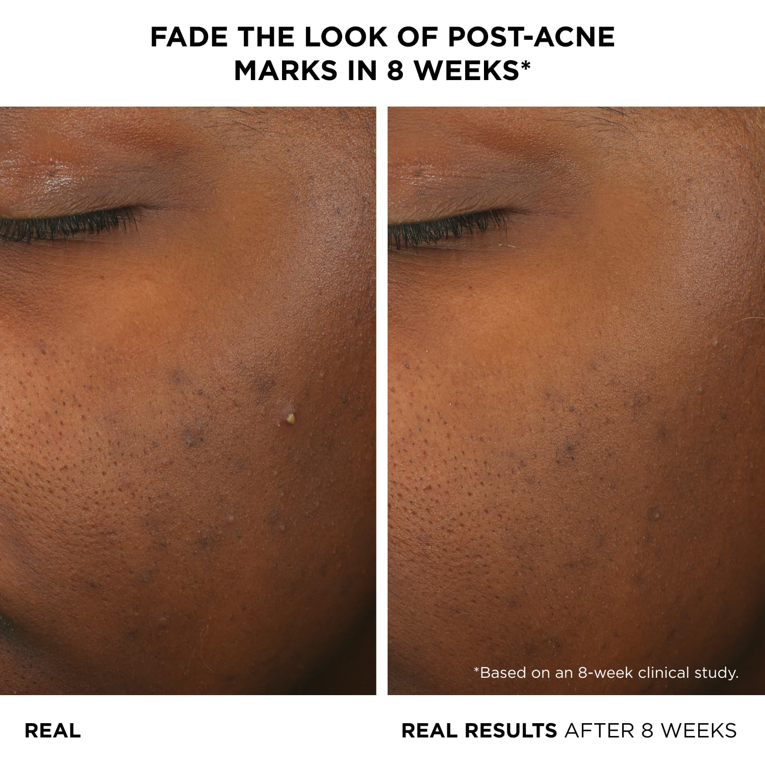 IT Cosmetics Bye Bye Breakout Acne Treatment Face Serum -With 2% Salicylic Acid & 3% Lactic Acid - Helps Reduce Pimples in 3 Days & Fades Look of Post-Acne Marks in 8 Weeks - 1 Fl. Oz