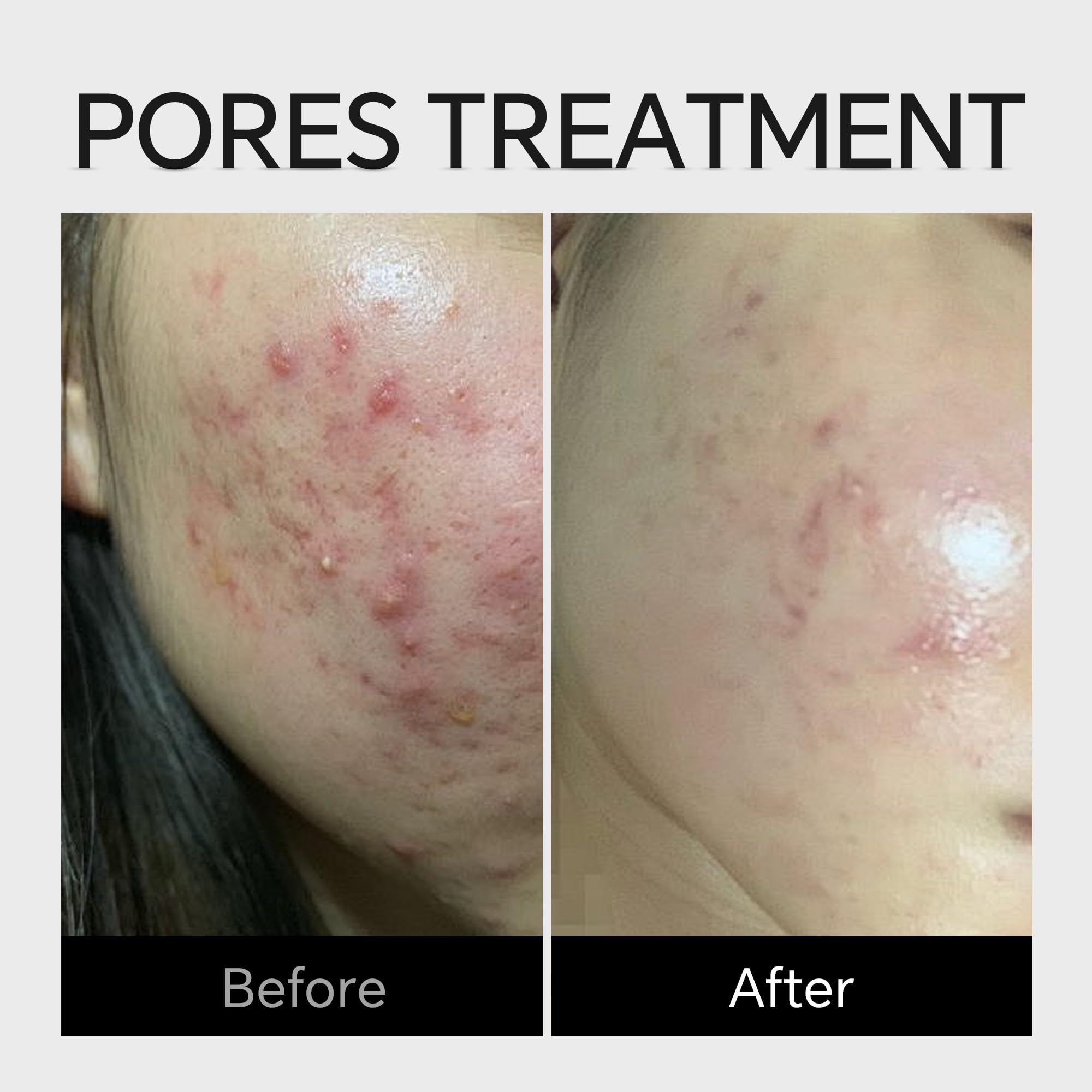 Azelaic Acid Serum Cream 10% Cystic Acne, Rosacea Treatment, Redness Relief, Hormonal Acne, Blemishes, Post-blemish Mark, Pore Refining, Sensitive Friendly Face & Back 1.59Oz