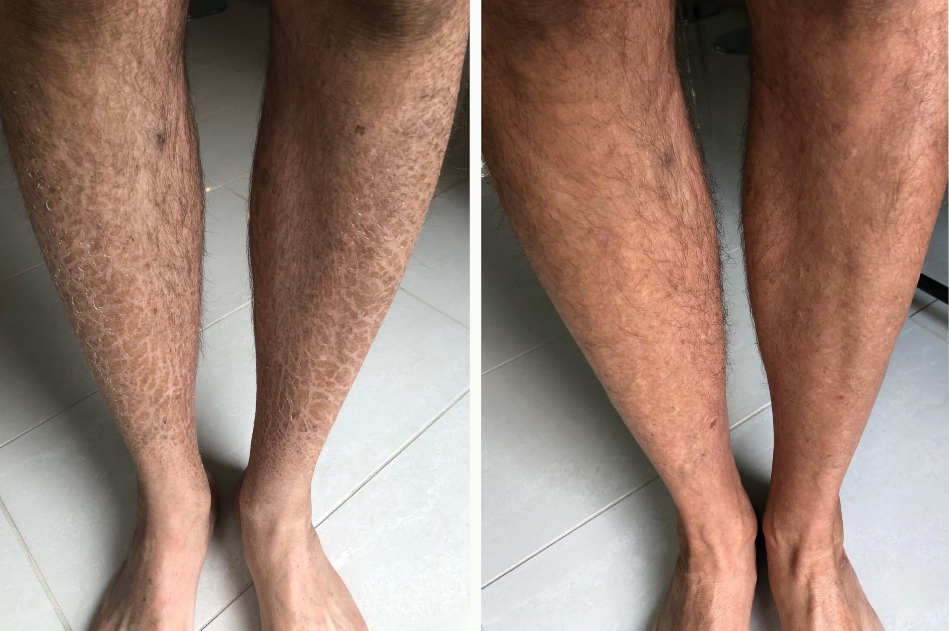 Sr Lotion, Excellent Ichthyosis Treatment, Outstanding Results In 2 Weeks