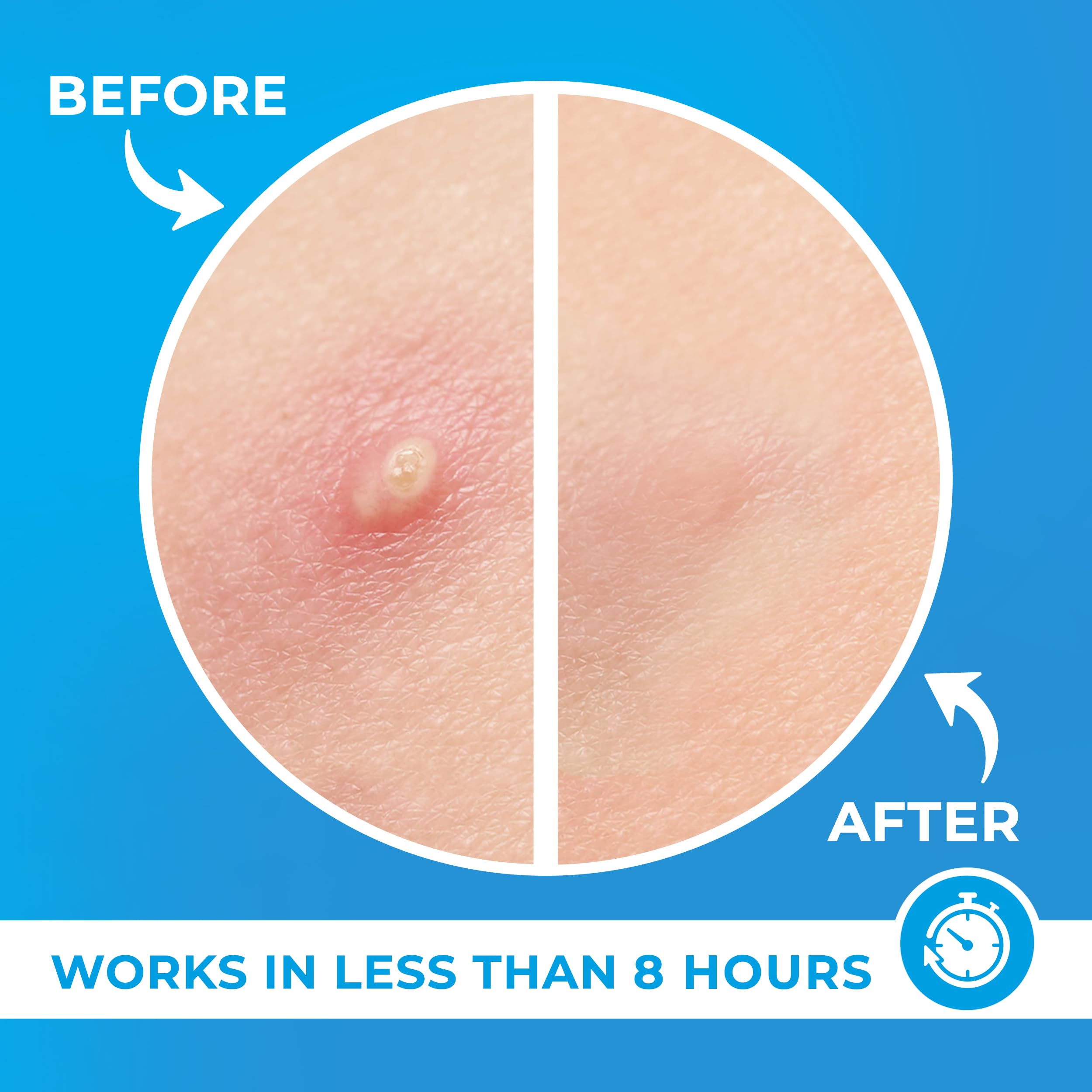 PatchRx Pimple Patches for Face (120 Patches), Hydrocolloid Acne Patches with Tea Tree Oil, Pimple Patch Pimple Stickers - Hydrocolloid Patch Acne Dots - Acne Pimple Patches For Face - Zit Patches