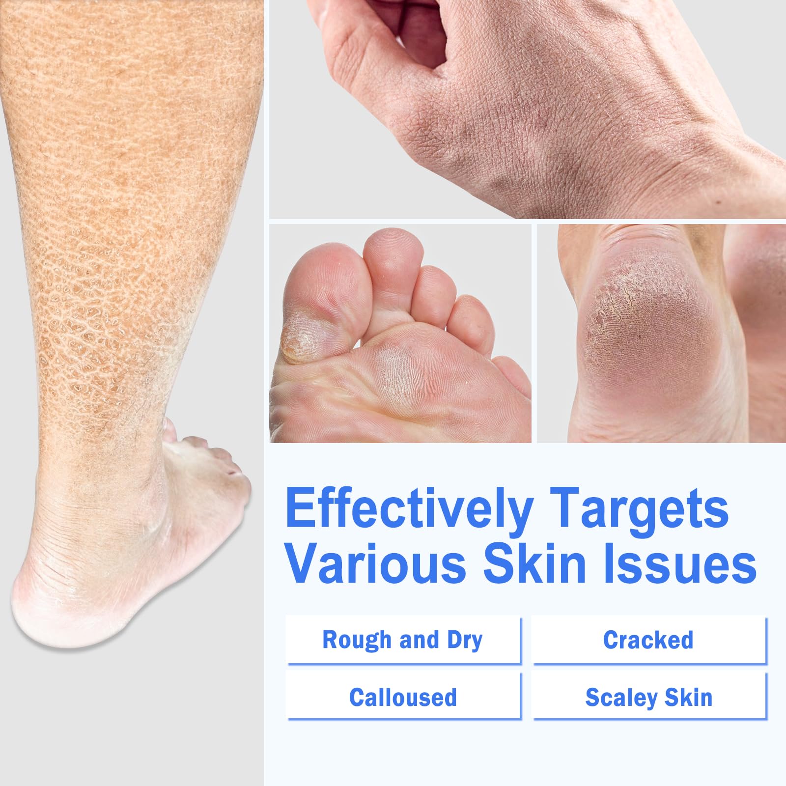 TEAWOO Ultra-Hydrating Foot Cream (Urea Conc. 40.67%), Foot Cream for Dry Cracked Heels and Feet, Pair with Moisturizing Heel Socks for Cracked Heel Treatment, Heel Socks Included (5.29 OZ/150g)