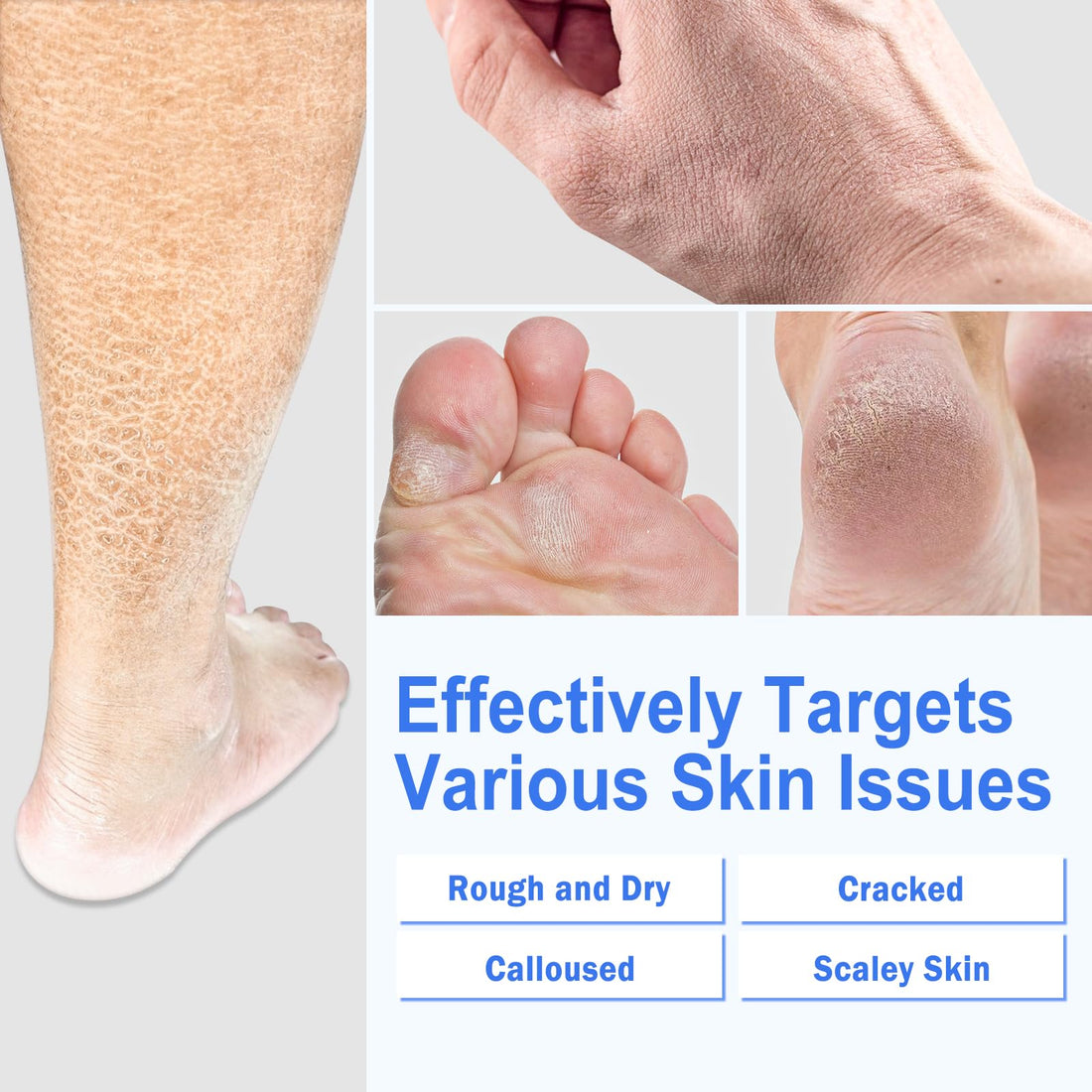 TEAWOO Ultra-Hydrating Foot Cream (Urea Conc. 40.67%), Foot Cream for Dry Cracked Heels and Feet, Pair with Moisturizing Heel Socks for Cracked Heel Treatment, Heel Socks Included (5.29 OZ/150g)