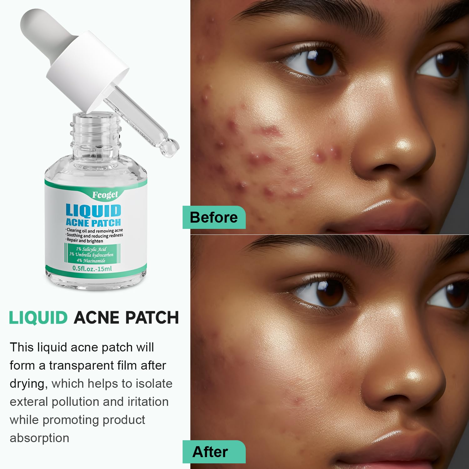 Fcoget Acne Spot Treatment Serum for Face, with 2% Salicylic Acid & 4% Niacinamide Face Serum, Liquid Pimple Patch for Acne Prone Skin, Soothing Redness, Clearing Oil Skin Care for Teens & Adults