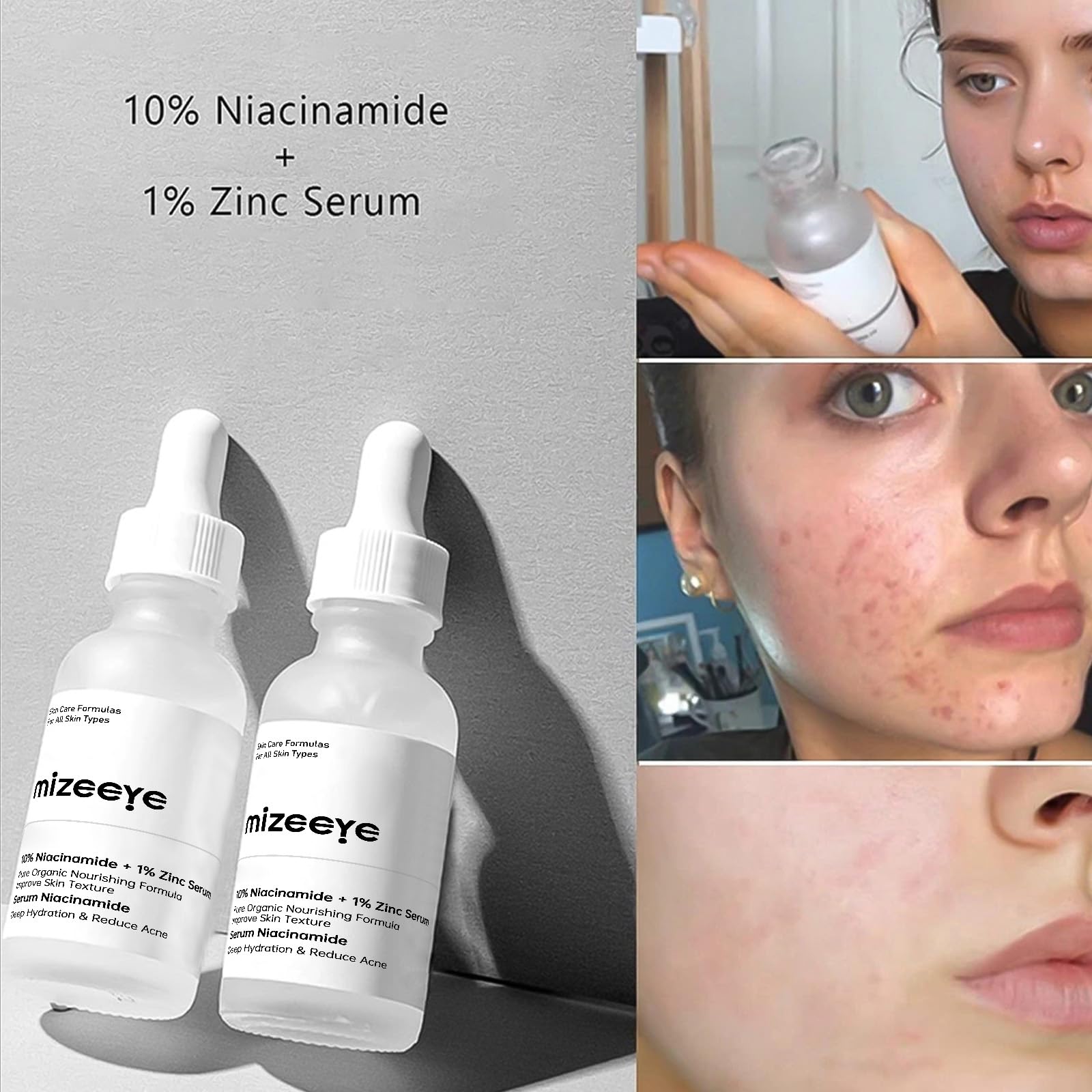 Niacinamide 10% + Zinc 1% Face Serum for Women, 30ML/1 Fl Oz Refreshing Niacinamide Serum for Face, Niacinamide Facial Serum For Acne.