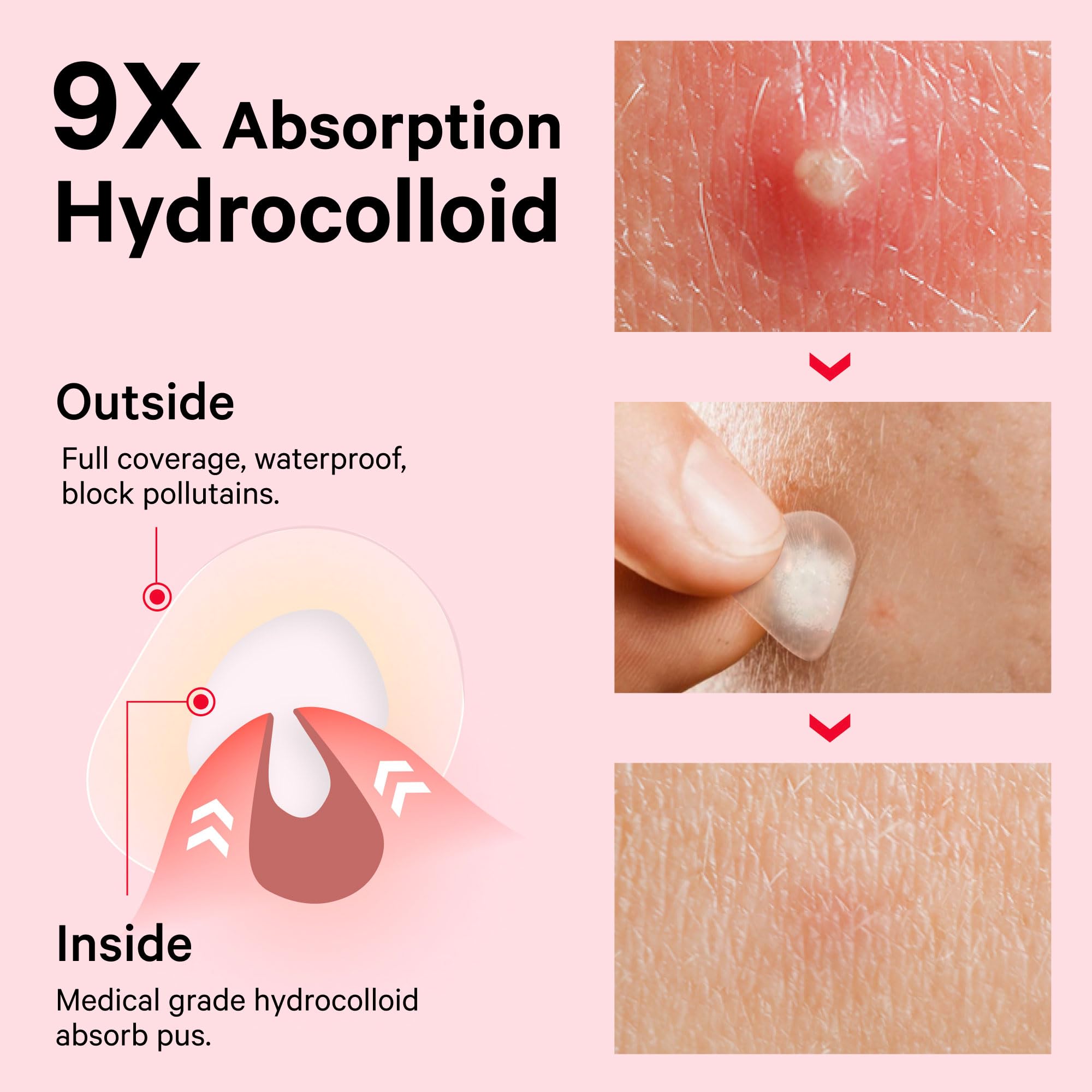 Sosky Pimple Patches for Face, FSA HSA Eligible Invisible Hydrocolloid Acne Patches, Zit Sticker for Face and Skin, Pimple Sticker for Covering Zits, Blemishes with Salicylic Acid 48 Count